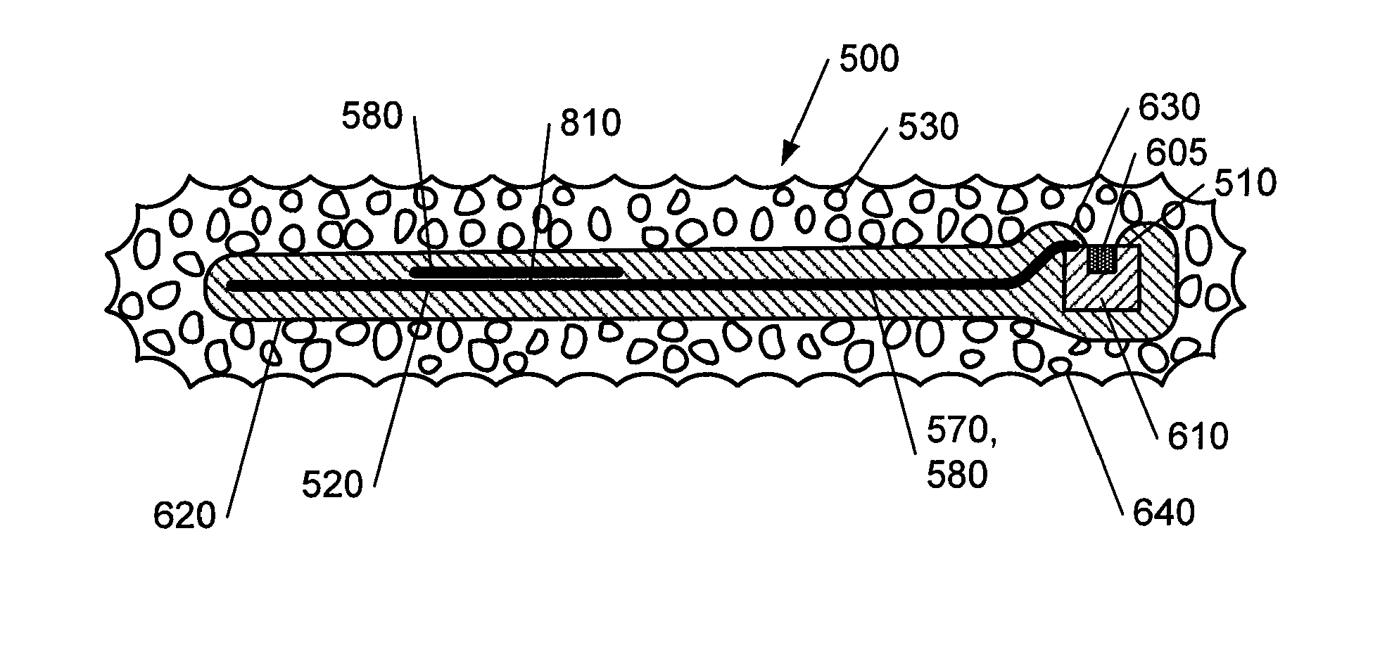 Device and method for glaucoma management and treatment