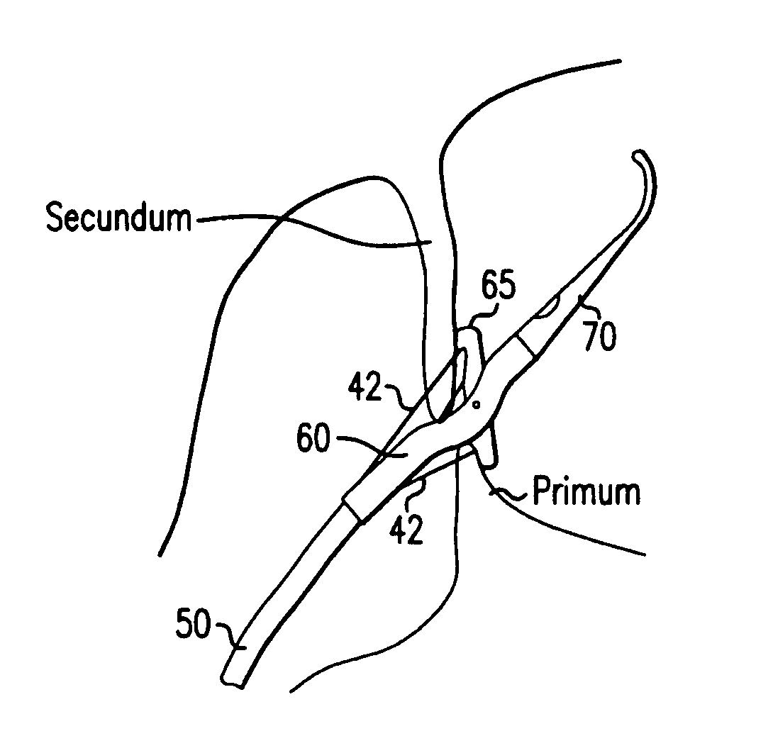 Device for suturing intracardiac defects
