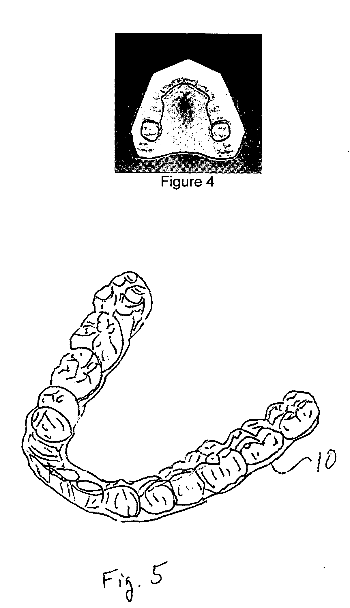 Two-phase invisible orthodontics