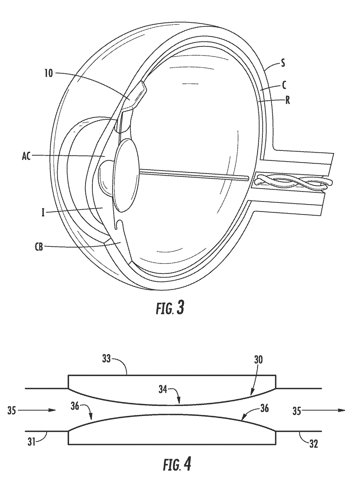 Apparatus for treating excess intraocular fluid