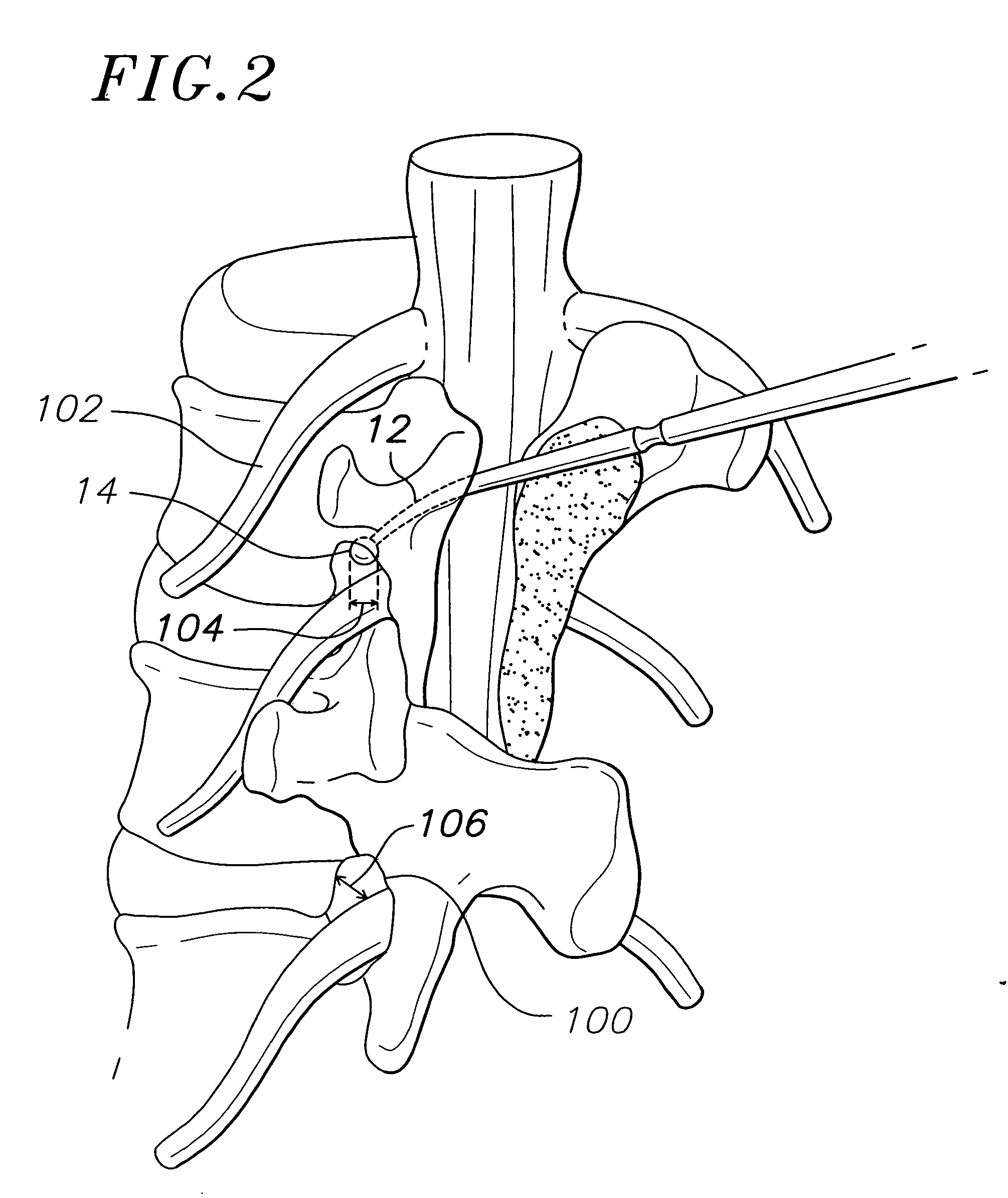 System, method and apparatus for locating, measuring, and evaluating the enlargement of a foramen