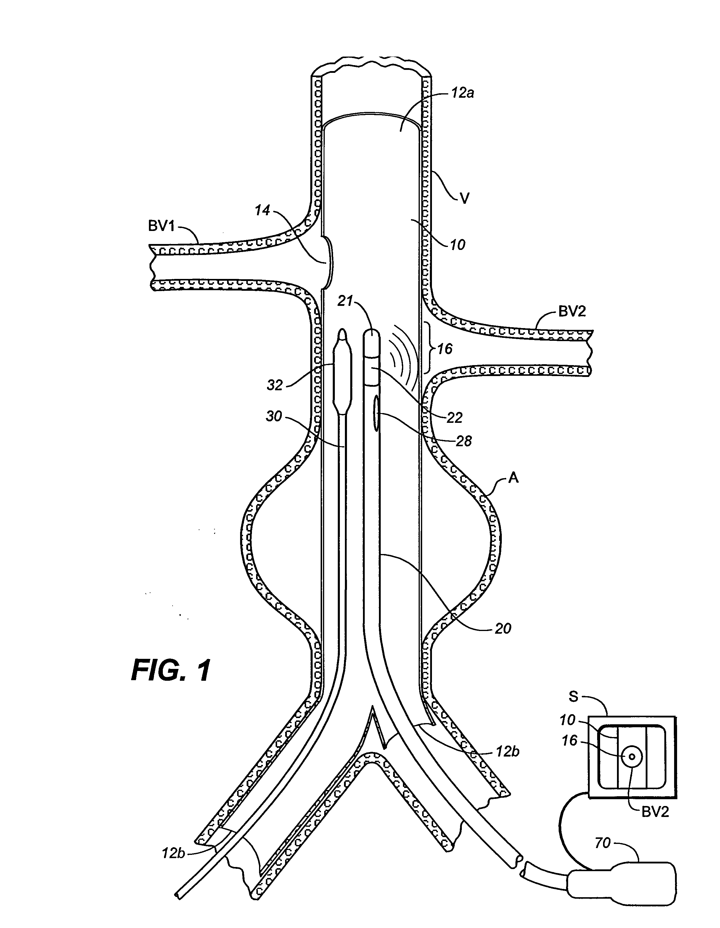 Multiple Branch Tubular Prosthesis and Methods