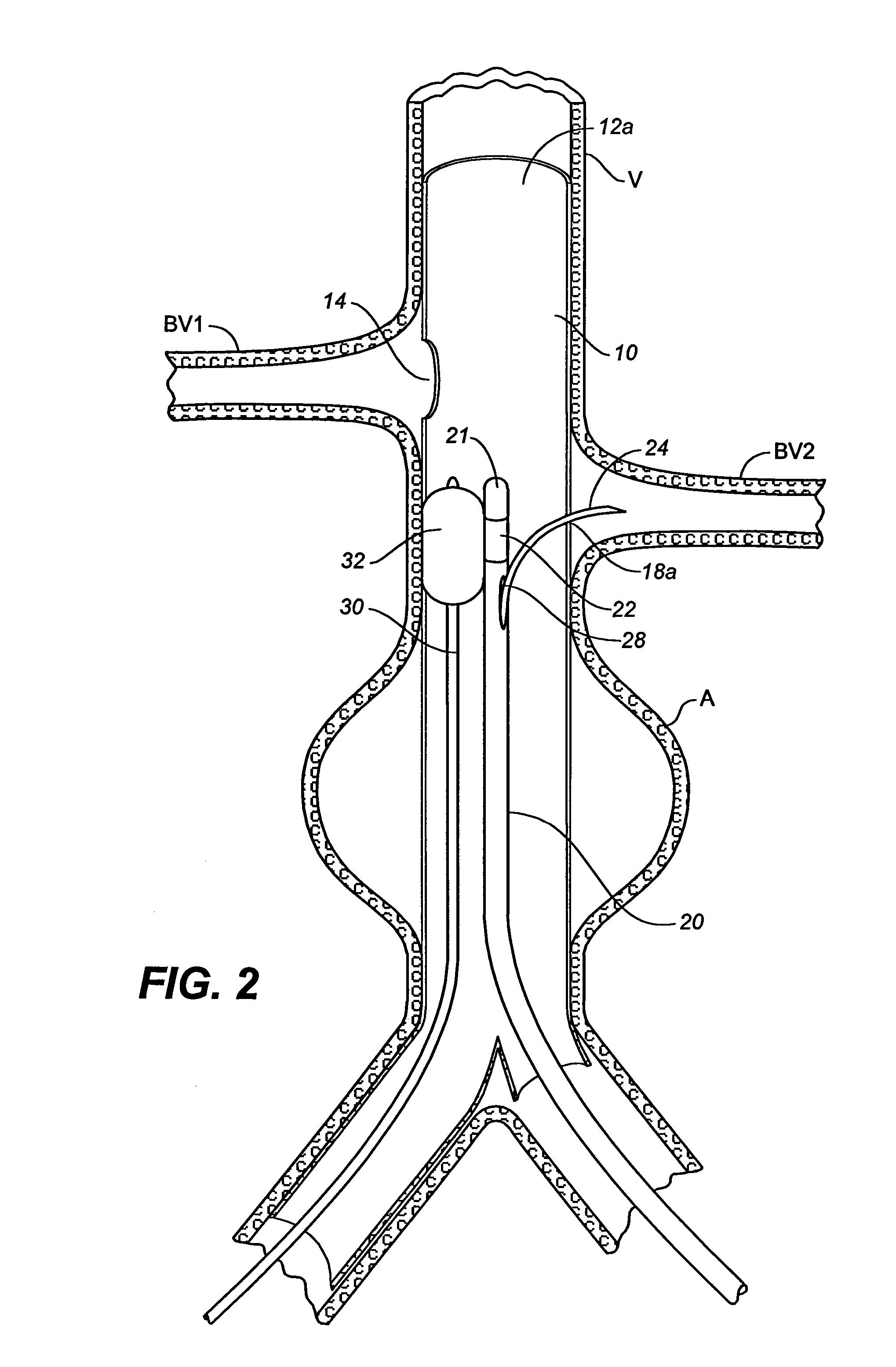 Multiple Branch Tubular Prosthesis and Methods