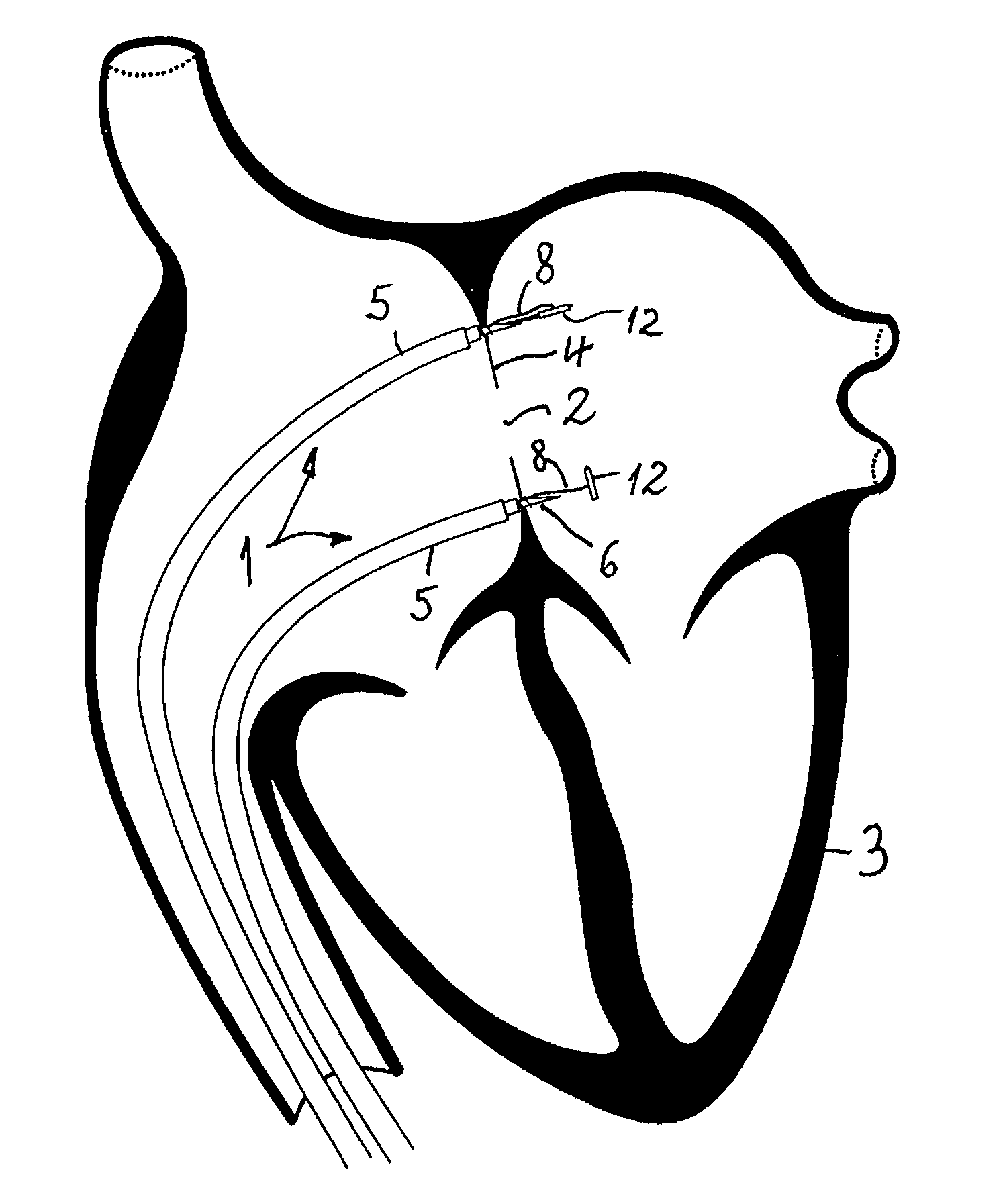 Device for closing an opening located in a heart septum