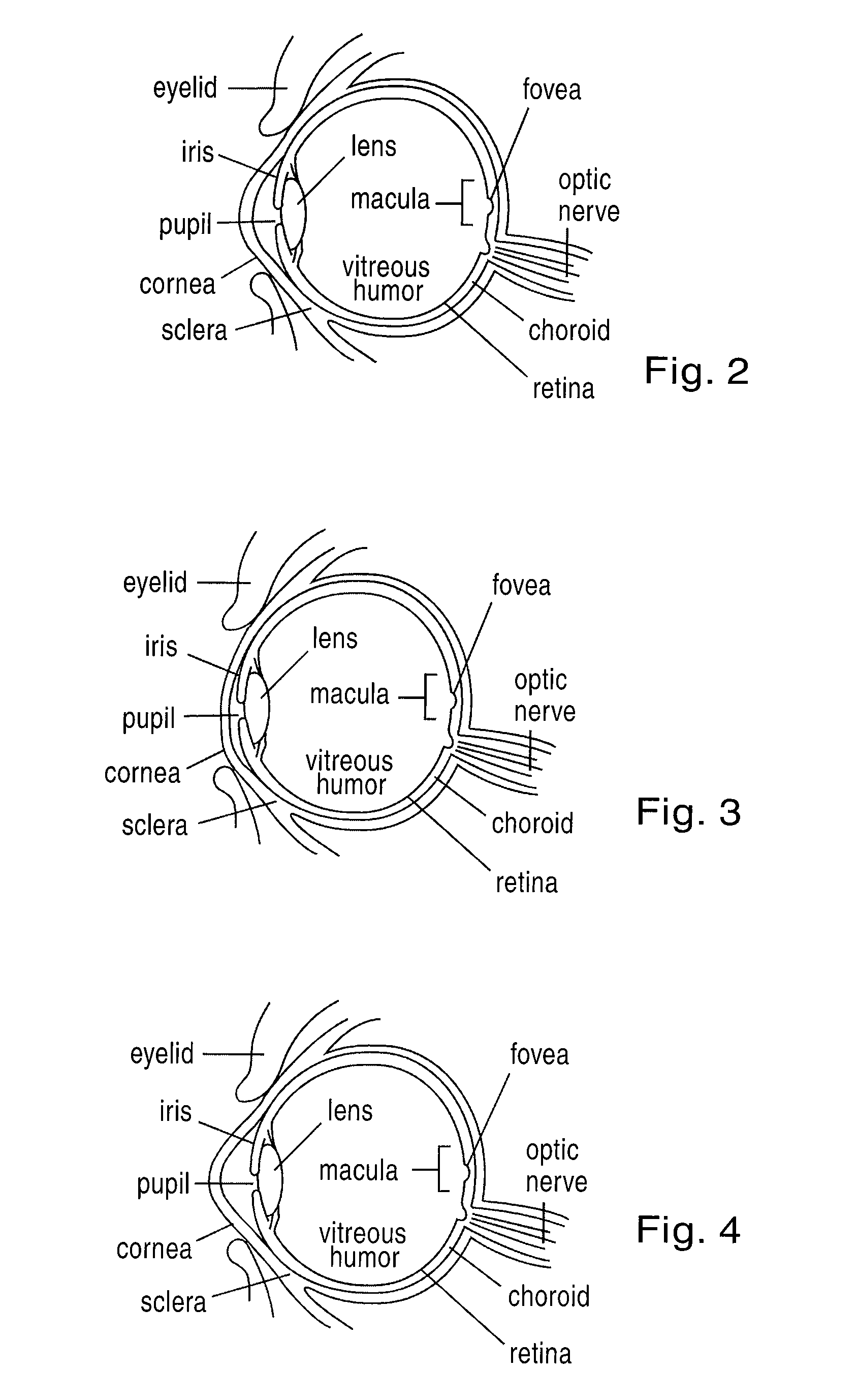Apparatus and method for treating visual disorders