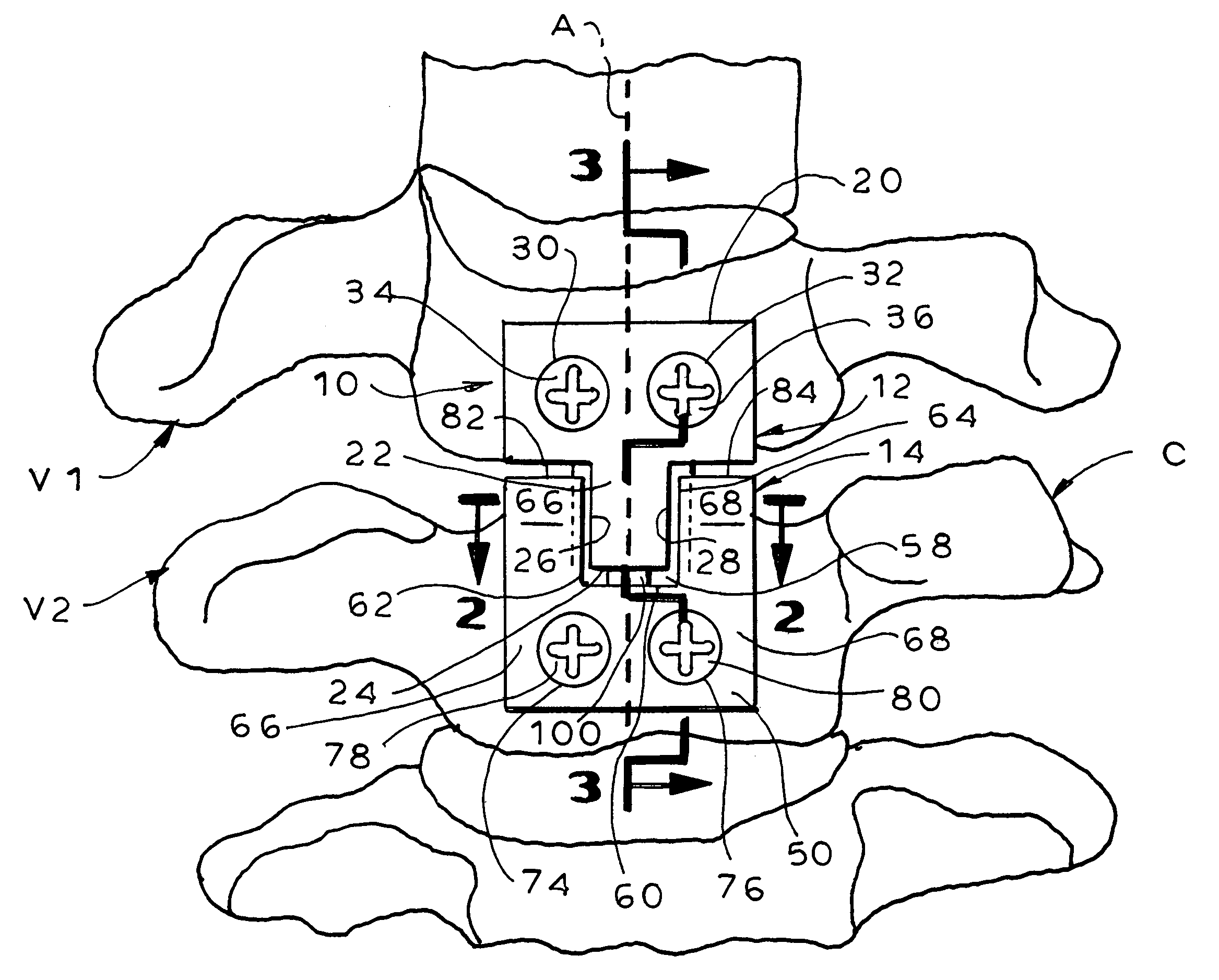 Methods and apparatus for promoting fusion of vertebrae