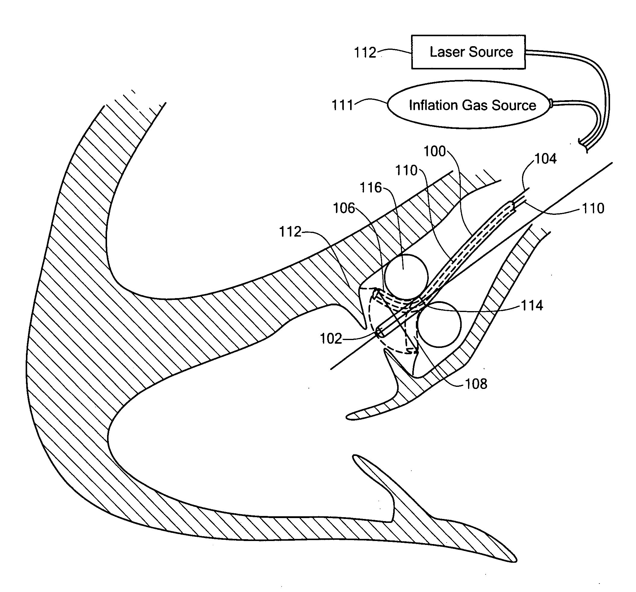 Endovascular tissue removal device