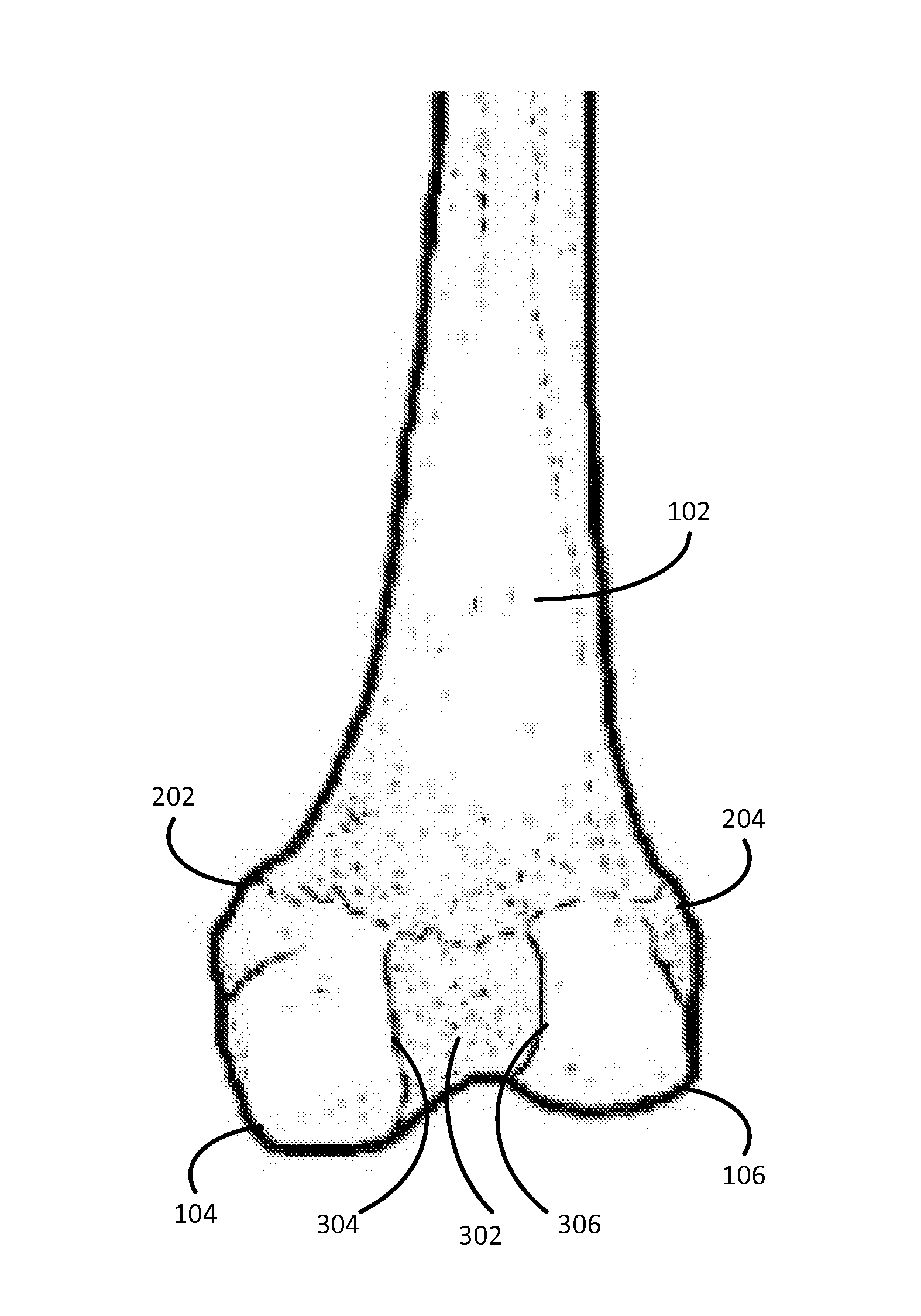 Method for knee resection alignment approximation in knee replacement procedures