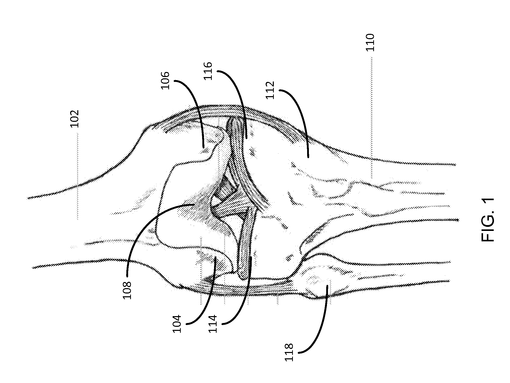 Method for knee resection alignment approximation in knee replacement procedures
