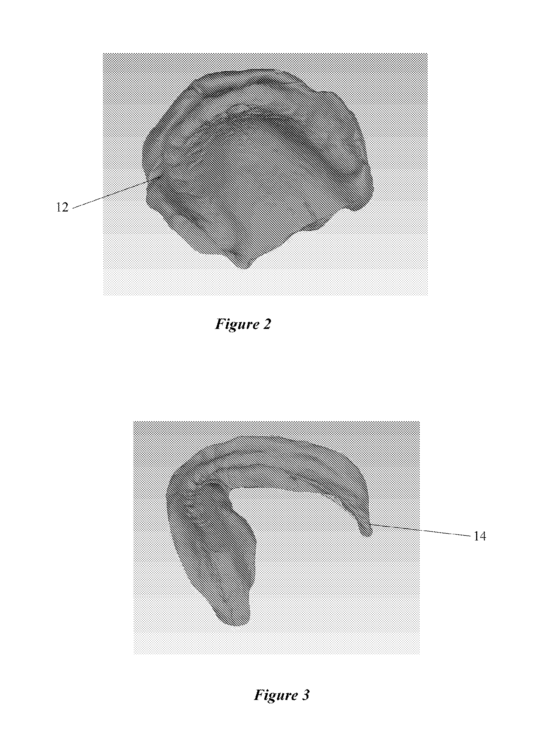 System and Processes for Optimization for Dentures