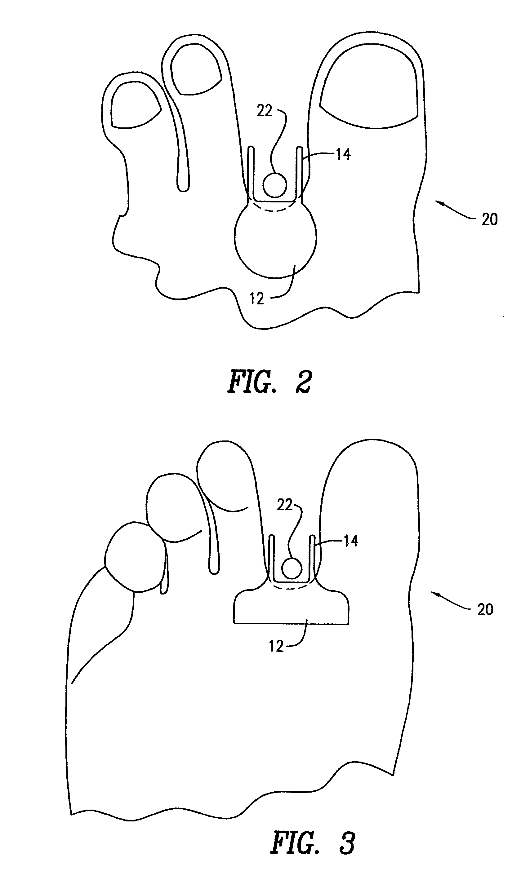 Protective device against frictional irritation due to wearing thong-type sandals and other footwear