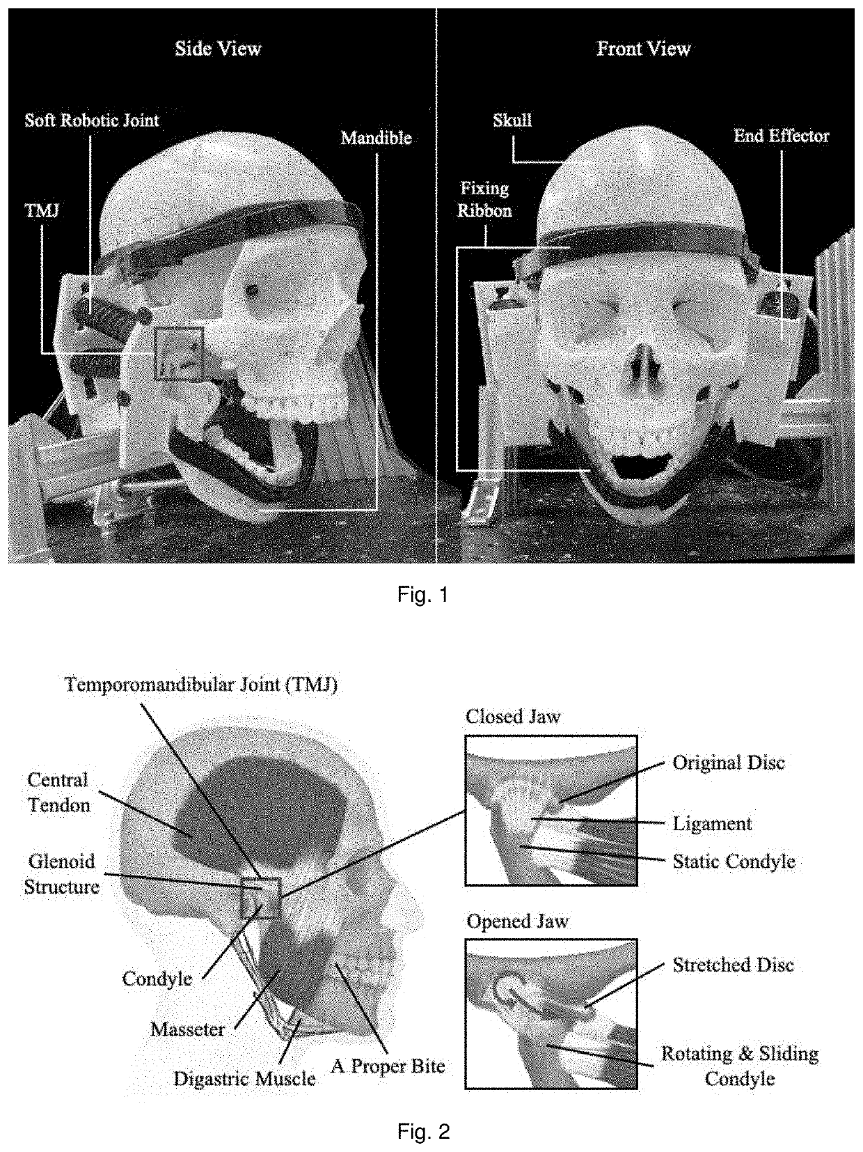 Soft exoskeleton wearable device for temporomandibular disorder (TMD) rehabilitation