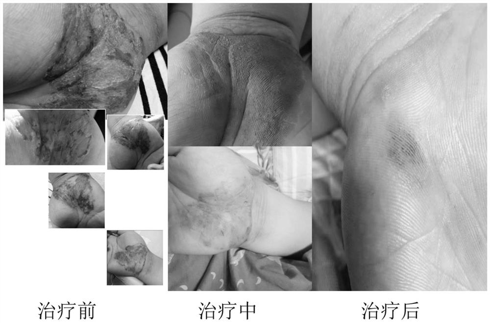 Combined medicine and plaster for treating various skin diseases and method for preparing plaster