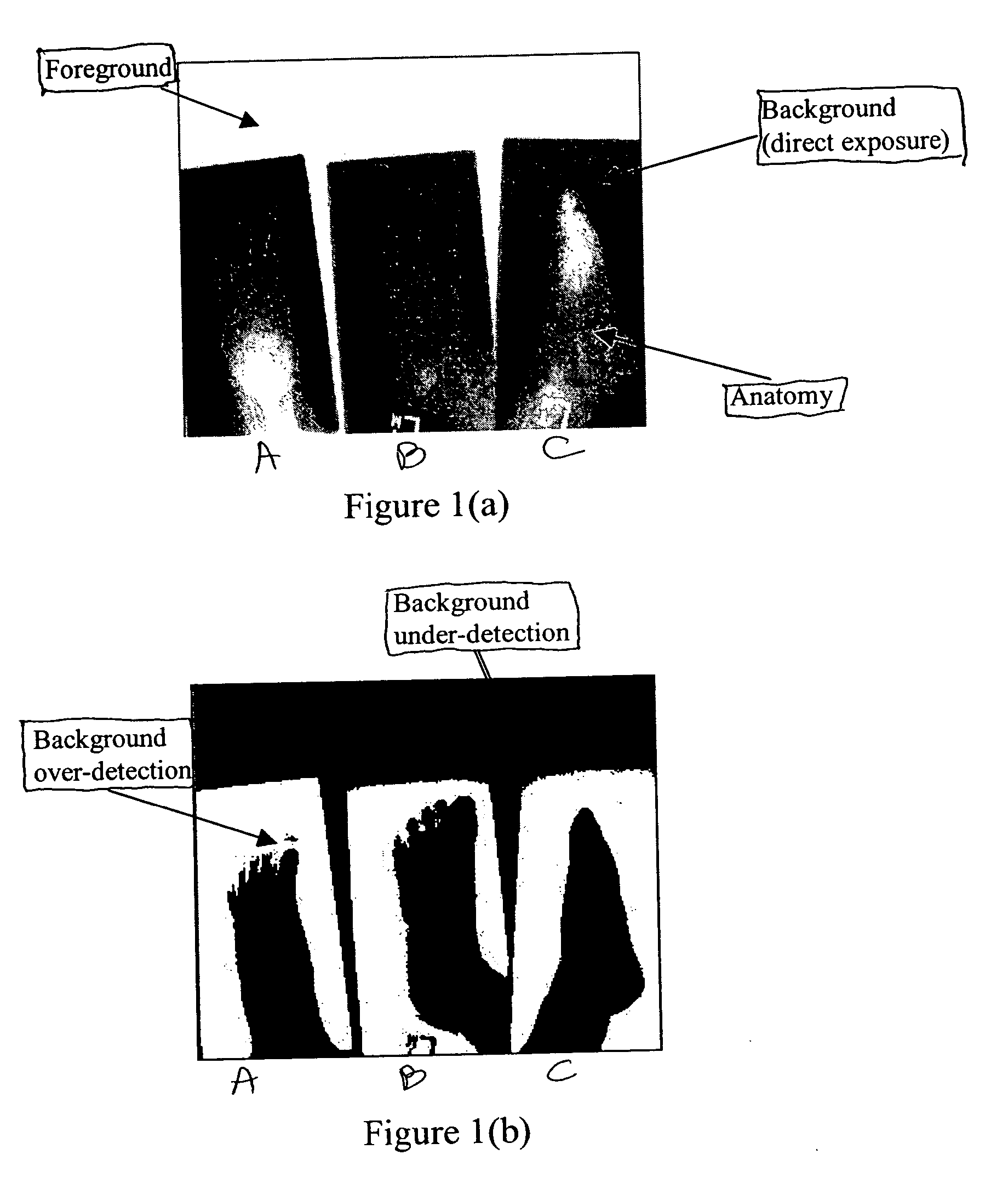 Method of segmenting a radiographic image into diagnostically relevant and diagnostically irrelevant regions