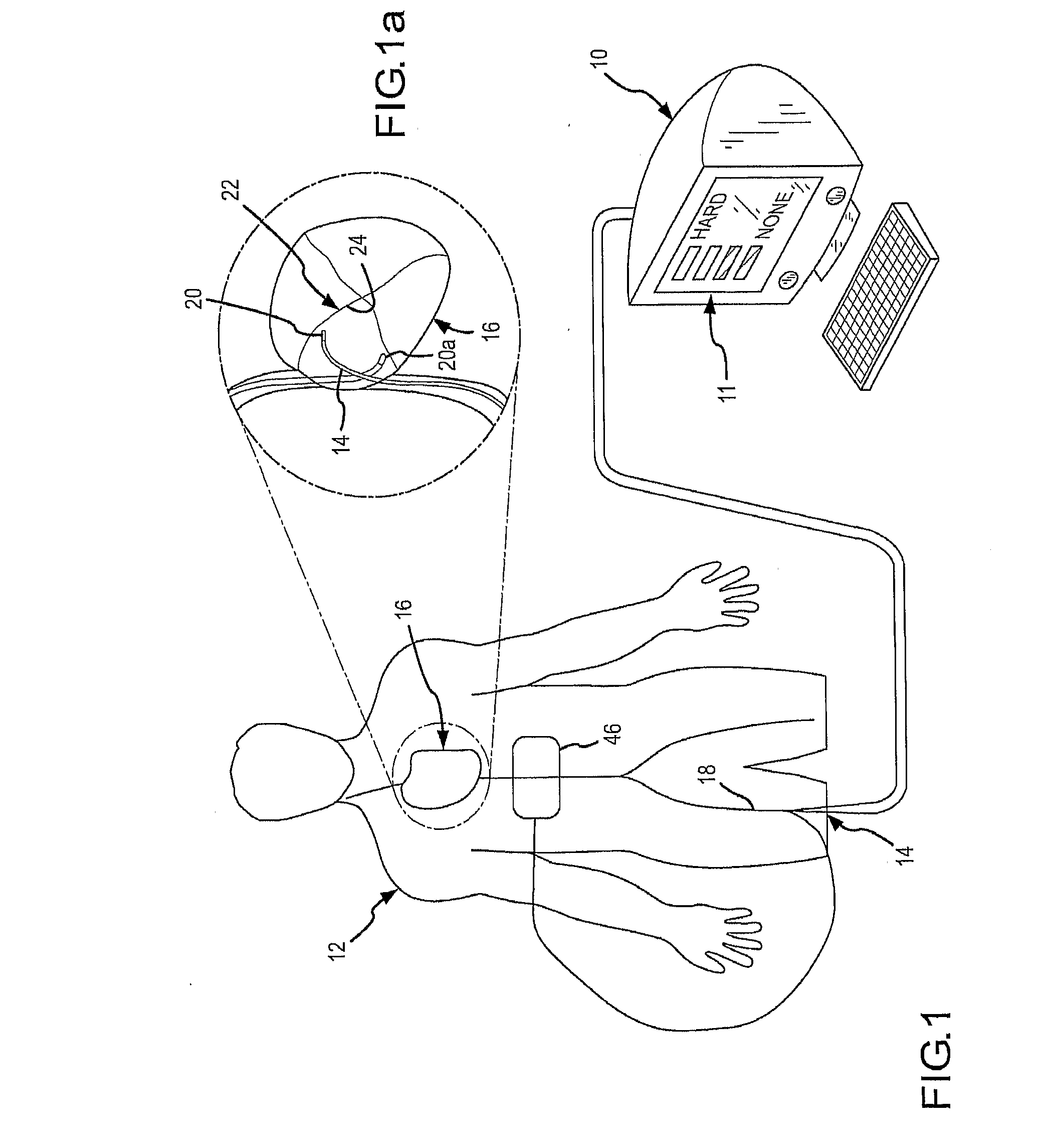 Method for Displaying Catheter Electrode-Tissue Contact in Electro-Anatomic Mapping and Navigation System