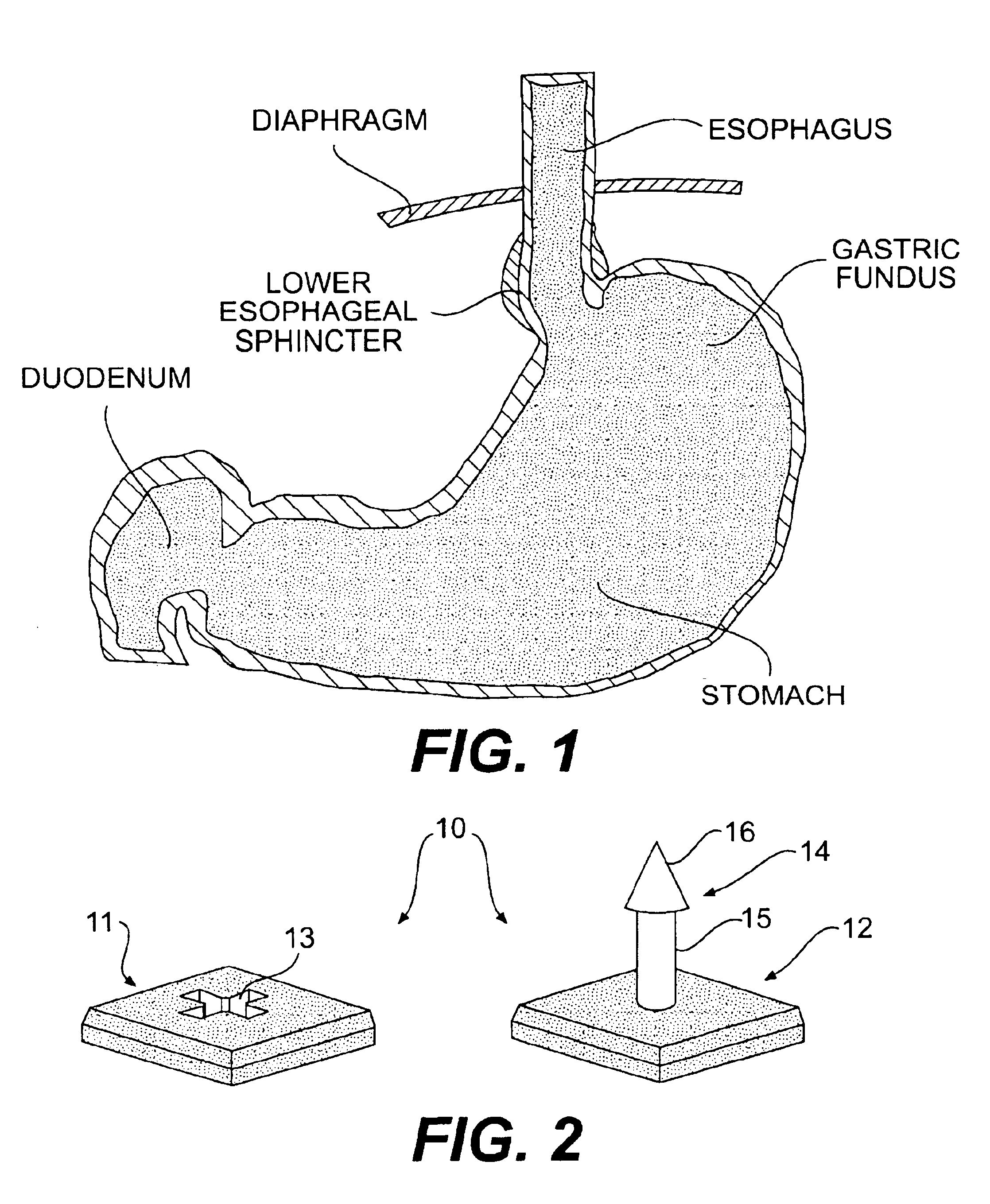 Devices and related methods for securing a tissue fold
