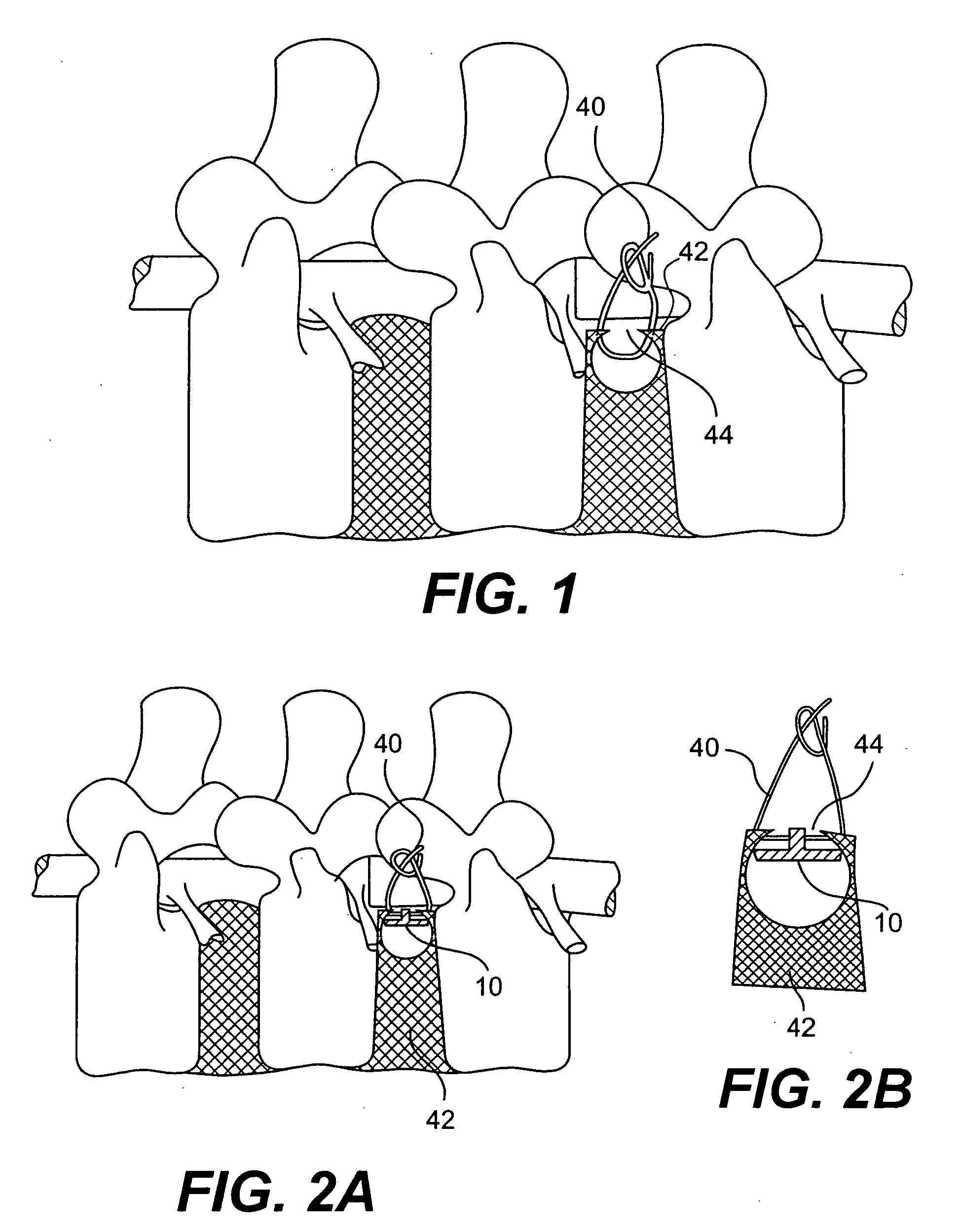 Method and apparatus for the treatment of the intervertebral disc annulus
