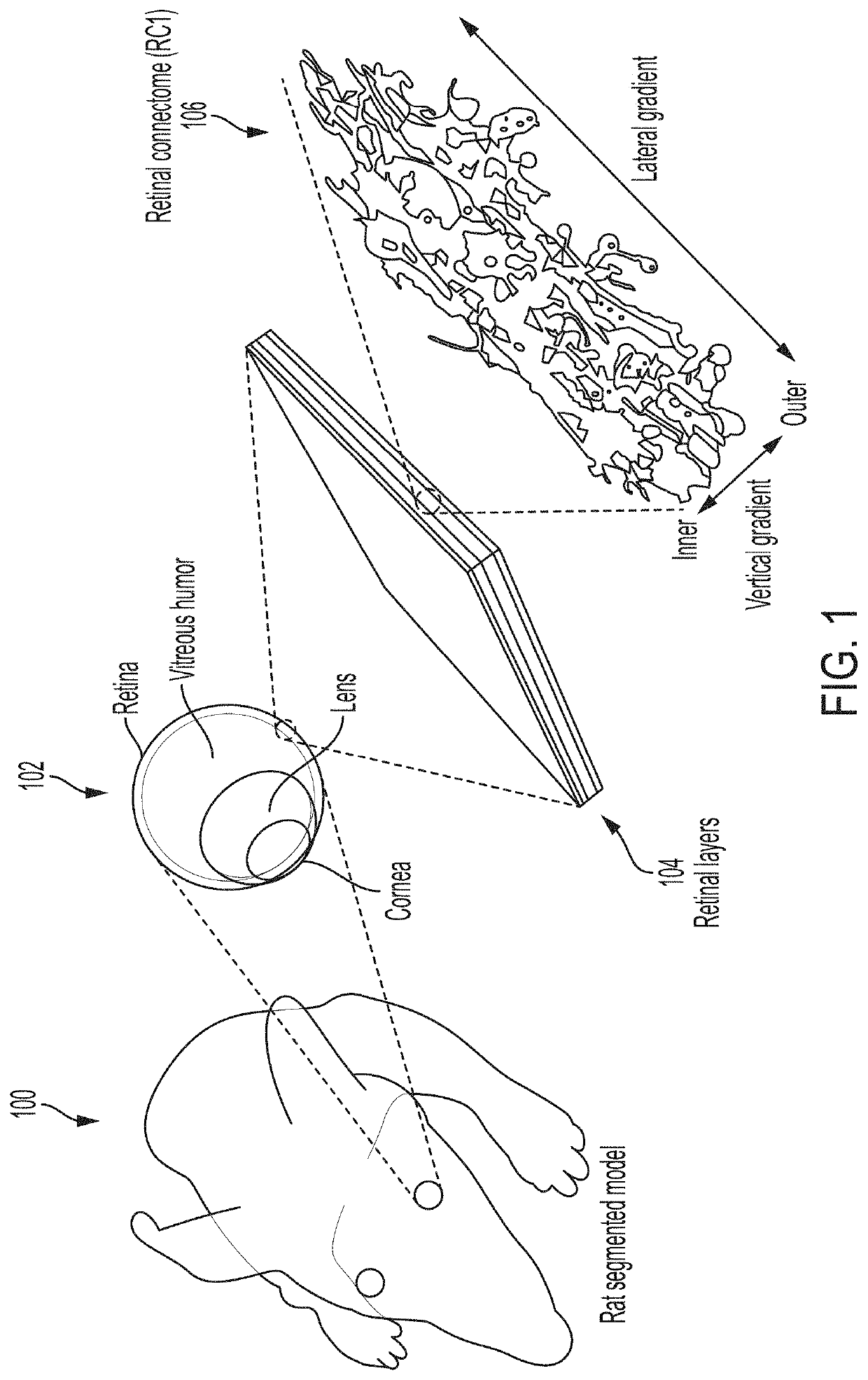 Bioelectronic lens (e-lens) system for electrical stimulation and neuroprotection of the retina