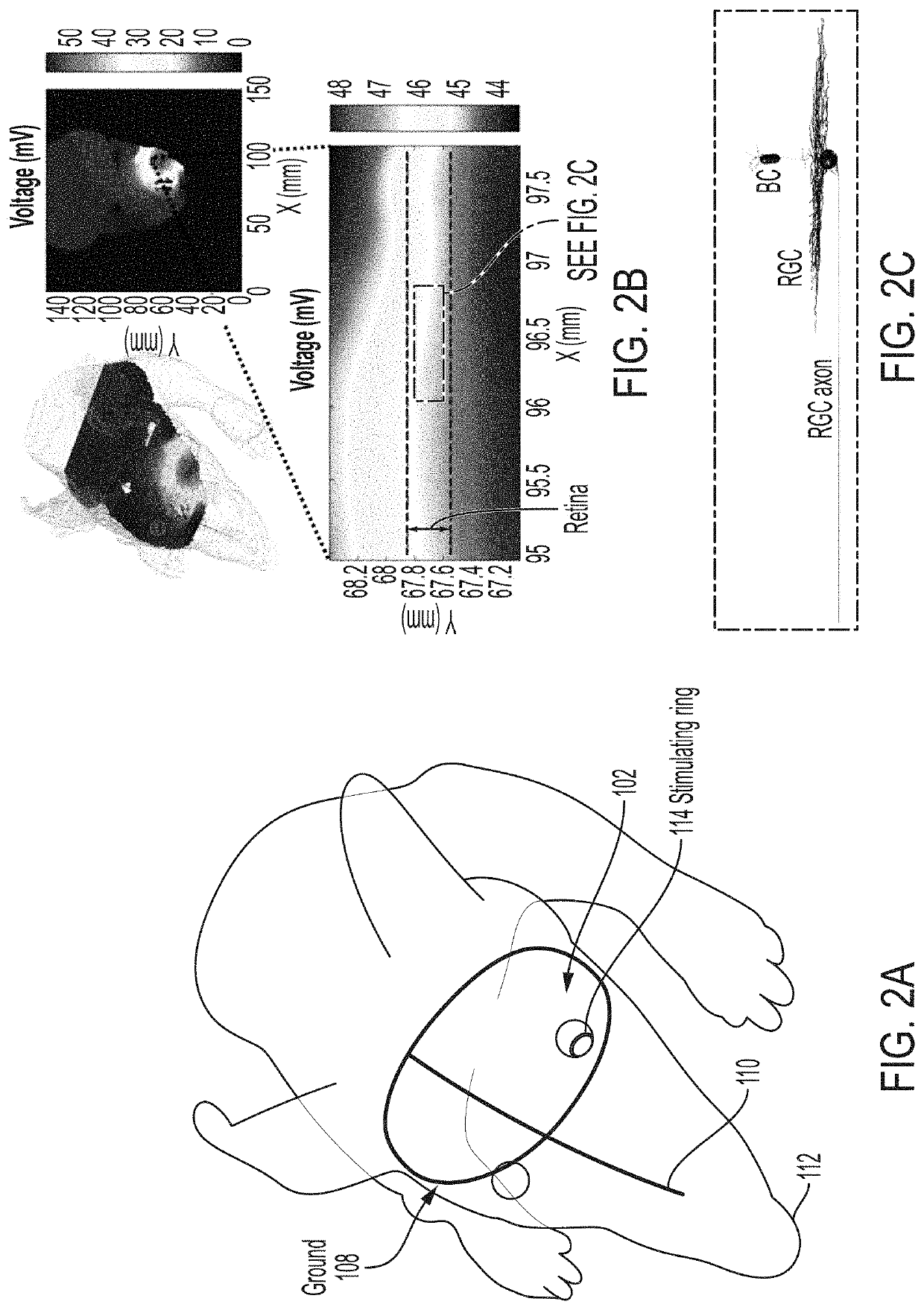 Bioelectronic lens (e-lens) system for electrical stimulation and neuroprotection of the retina
