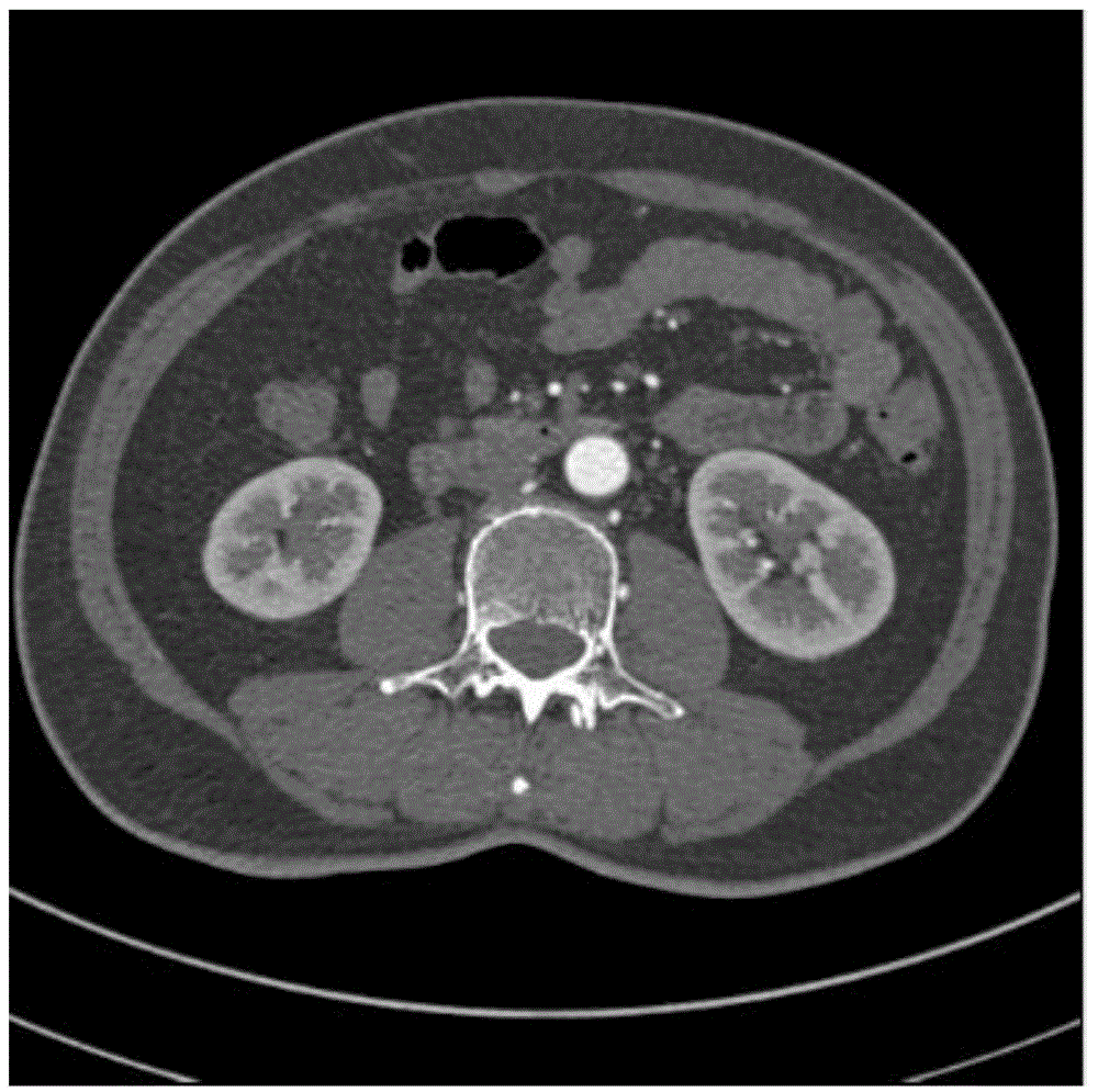 Full-automatic CT image kidney segmentation method