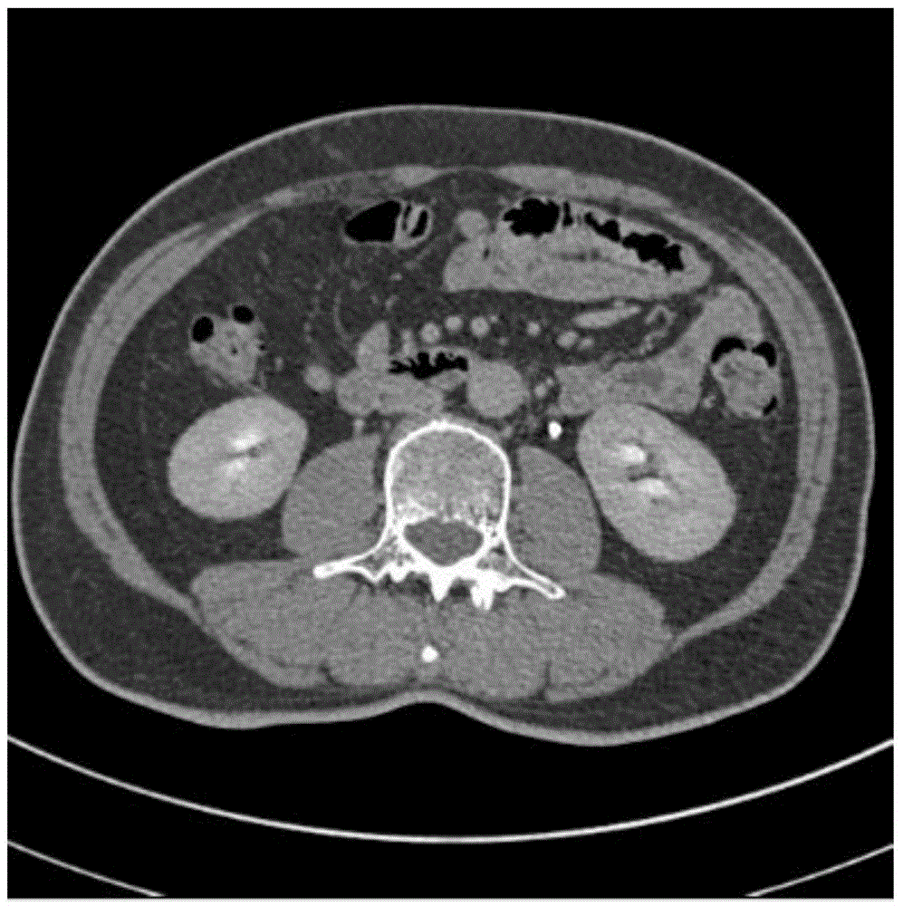 Full-automatic CT image kidney segmentation method