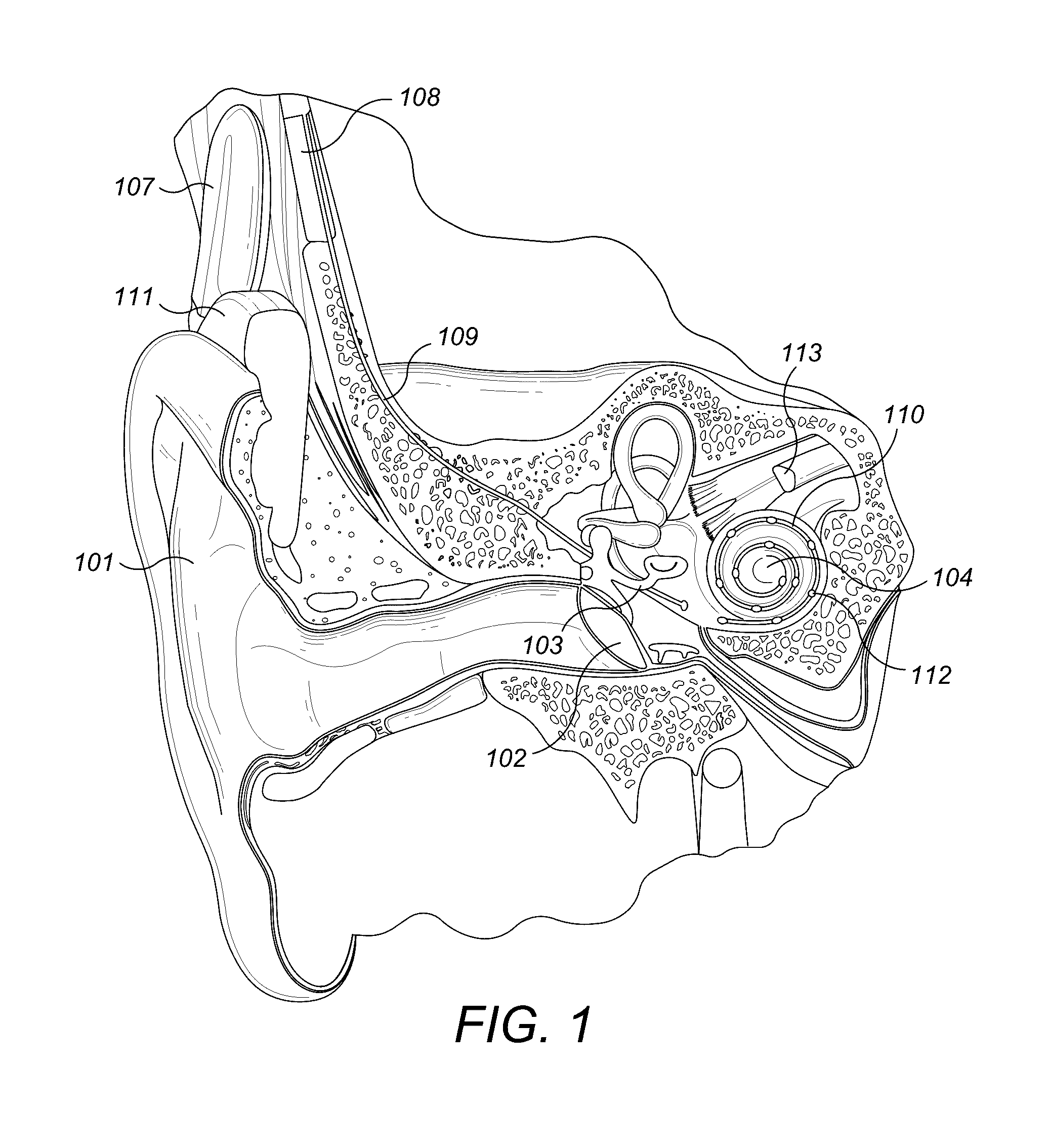 Modified electrode lead for cochlear implants