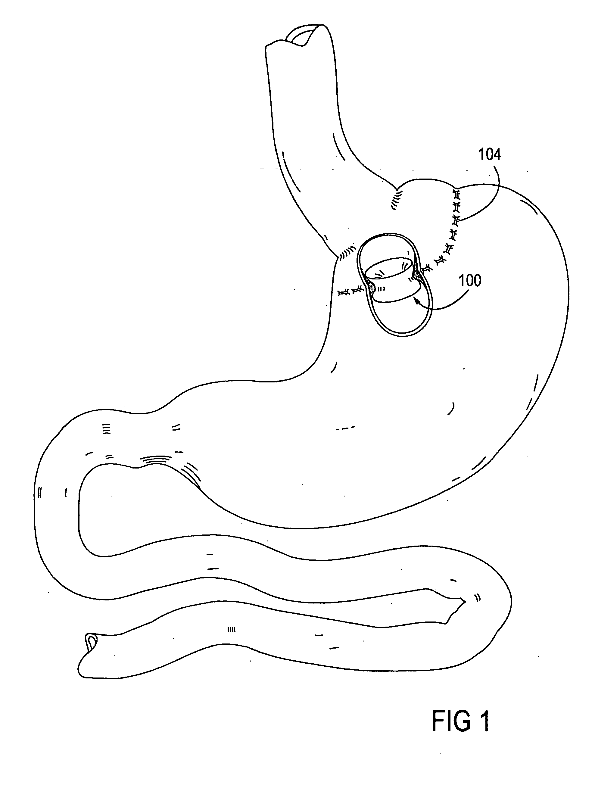 Gastrointestinal sleeve device and methods for treatment of morbid obesity