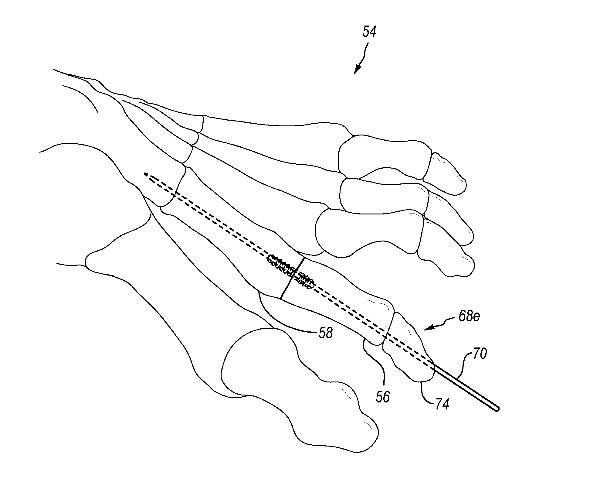 Systems and methods for implanting surgical implants