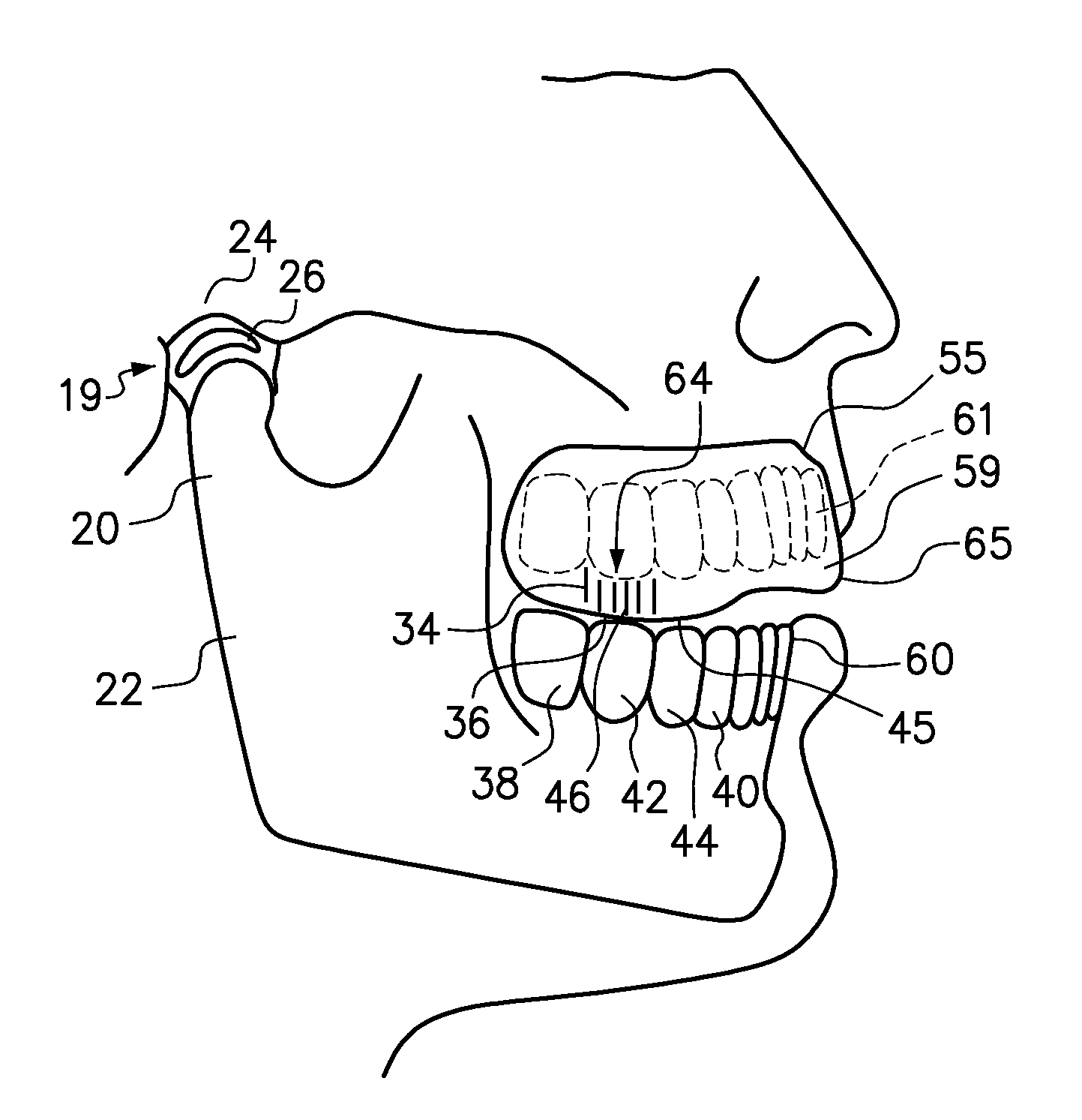 Mouthguard and method of manufacture therefor