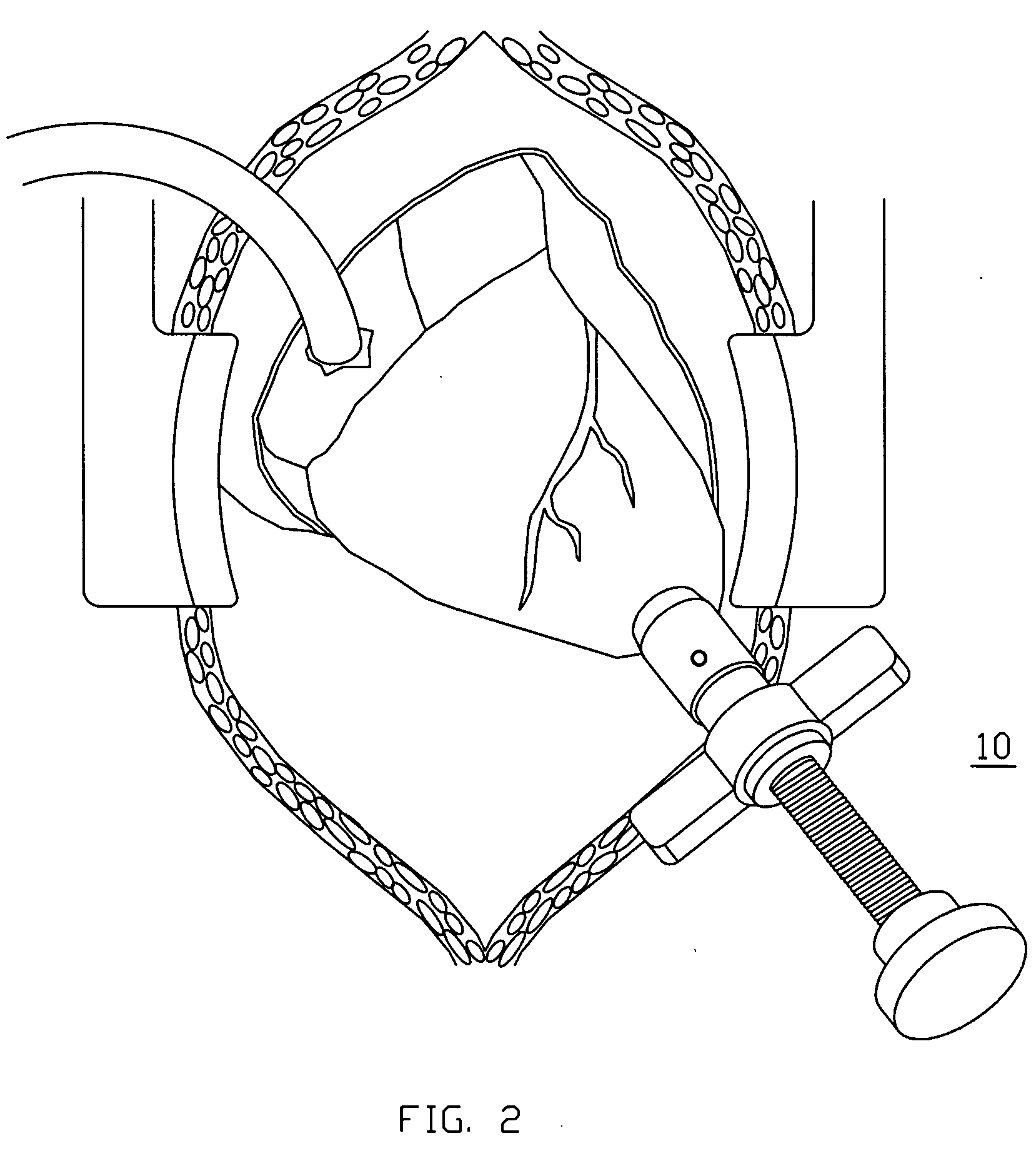 Method and apparatus for trephinating body vessels and hollow organ walls