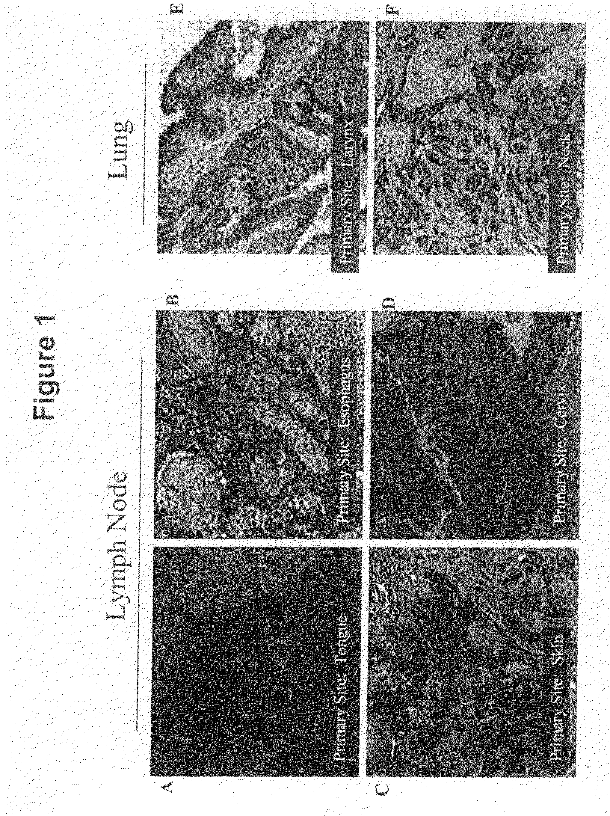 Compositions and methods for inhibiting growth of smad4-deficient cancers