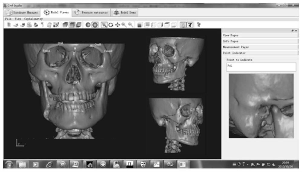 A database-based preoperative design method and device for bilateral jaw defect reconstruction