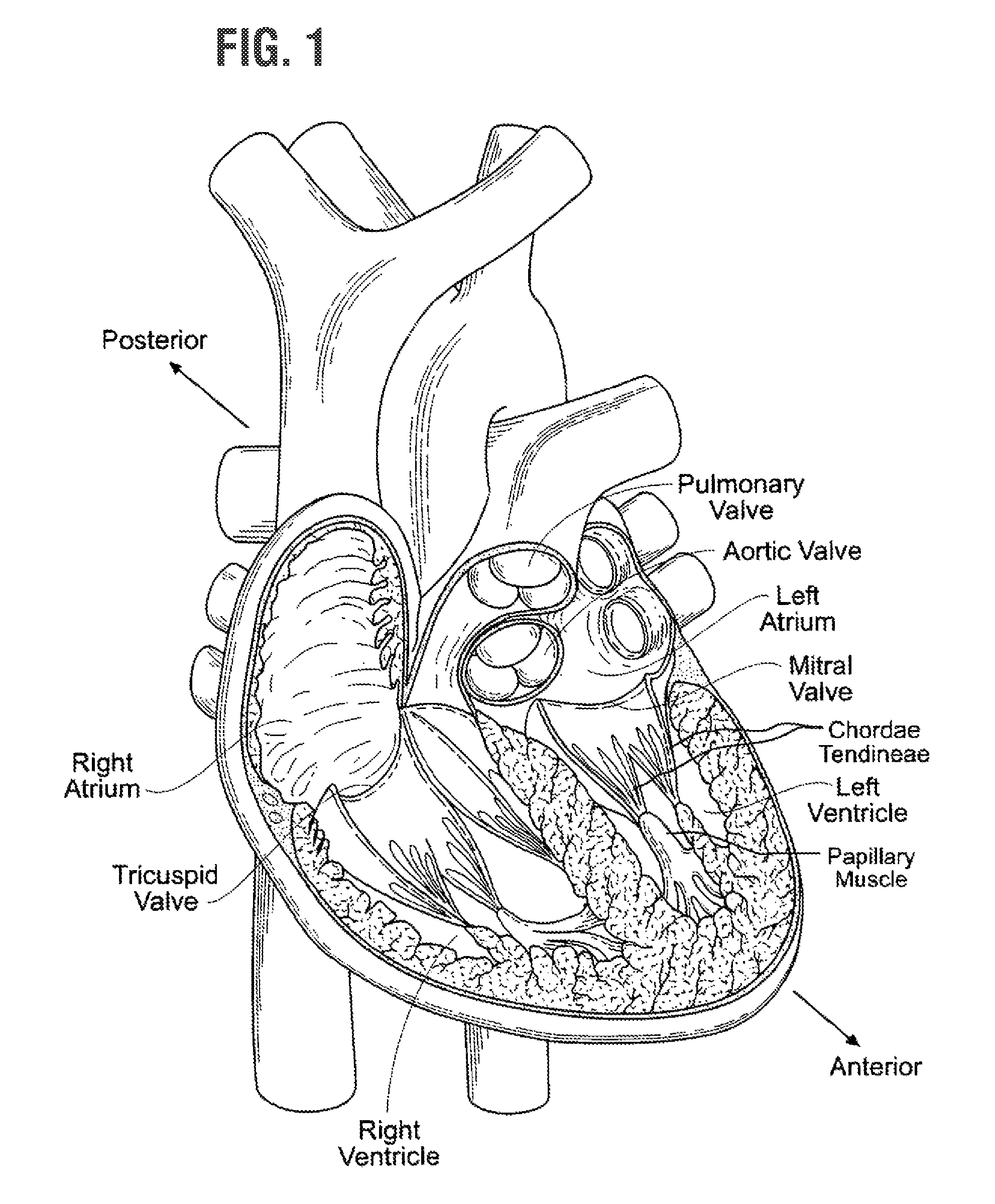 Rapidly deployable surgical heart valves