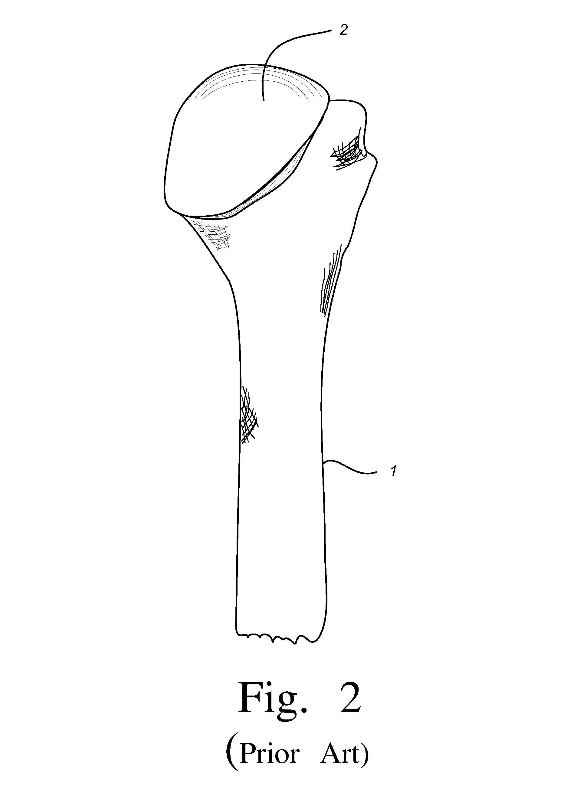 Extended articulation orthopaedic implant and associated method