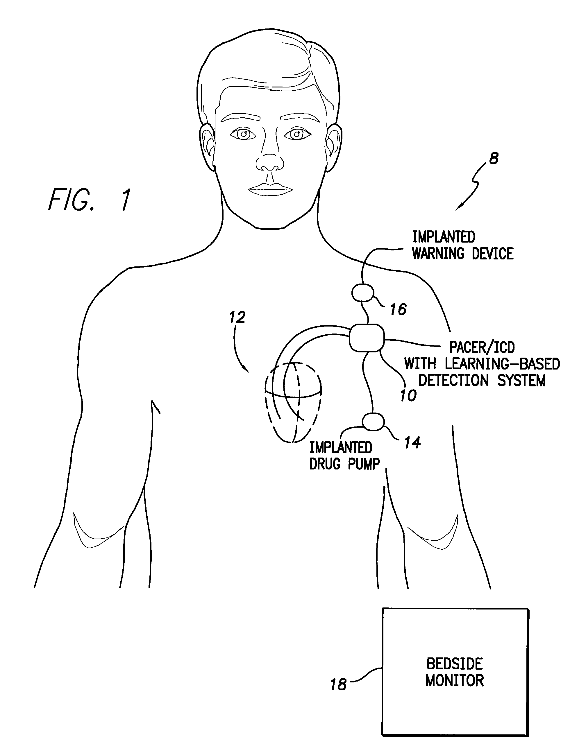 System and method for adaptively adjusting cardiac ischemia detection thresholds and other detection thresholds used by an implantable medical device