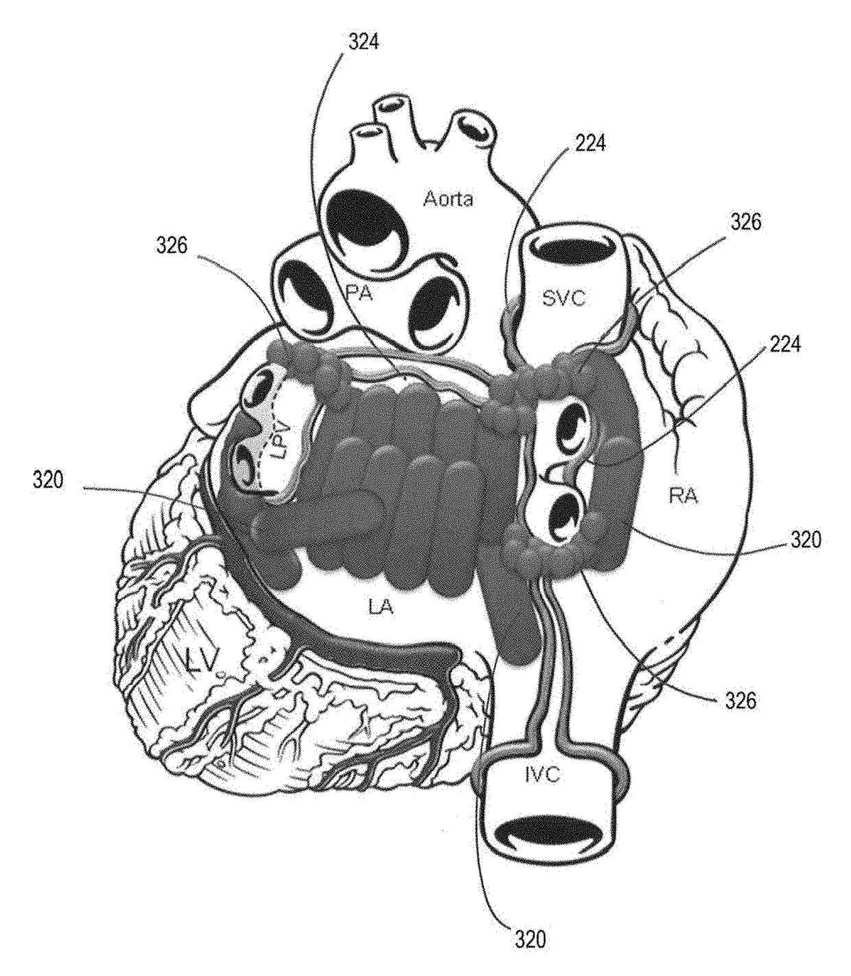 Methods to prevent stress remodeling of atrial tissue