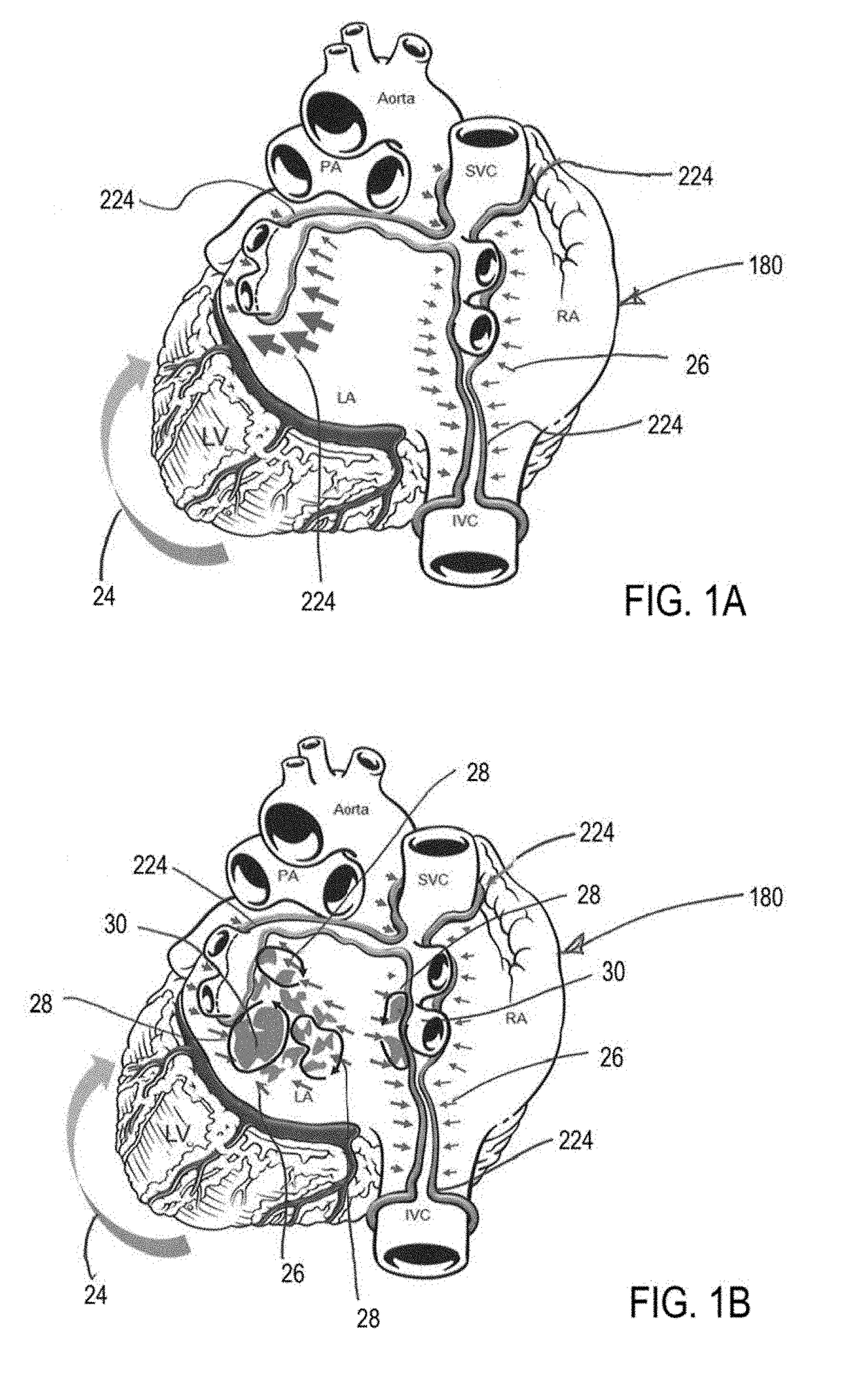 Methods to prevent stress remodeling of atrial tissue