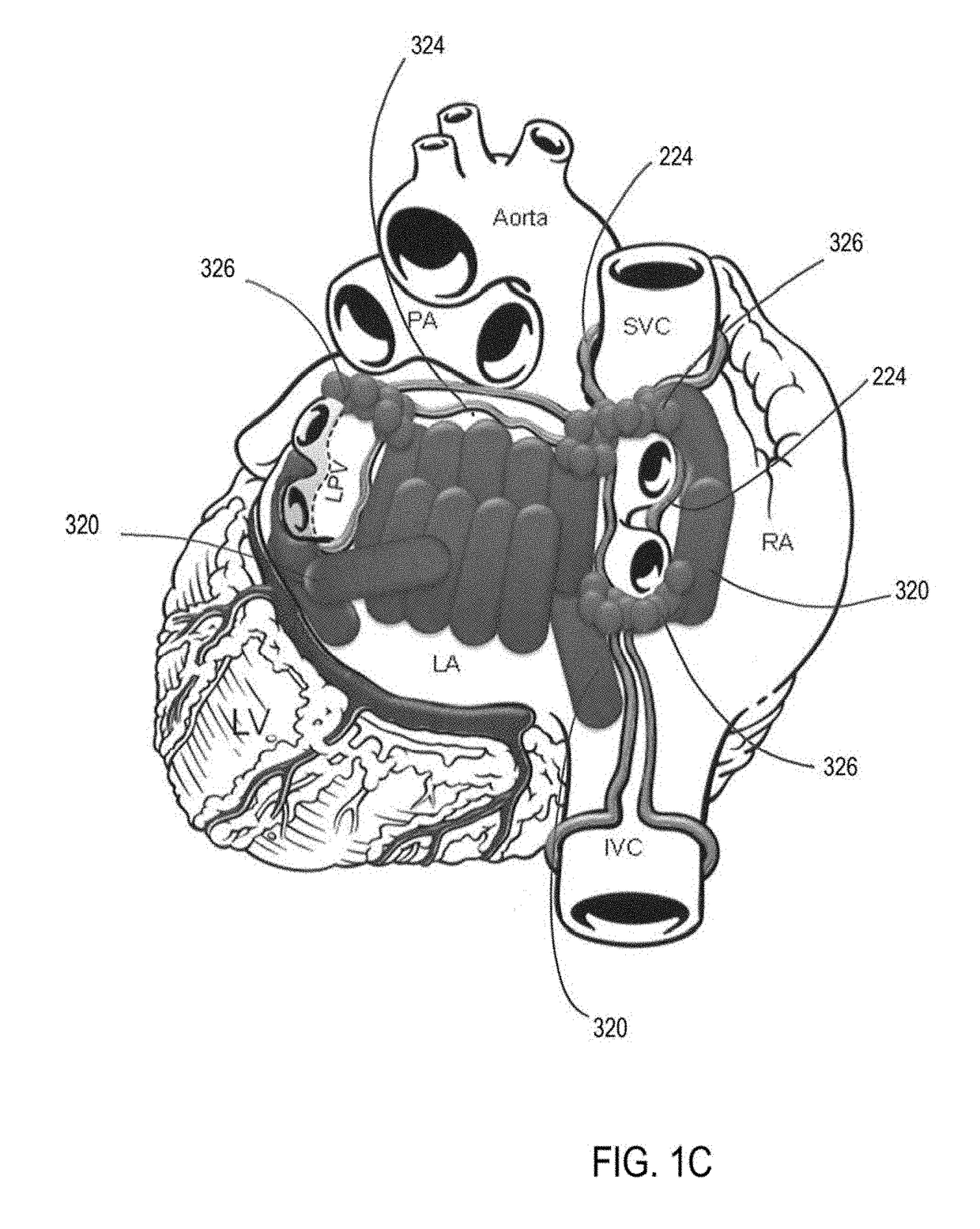 Methods to prevent stress remodeling of atrial tissue