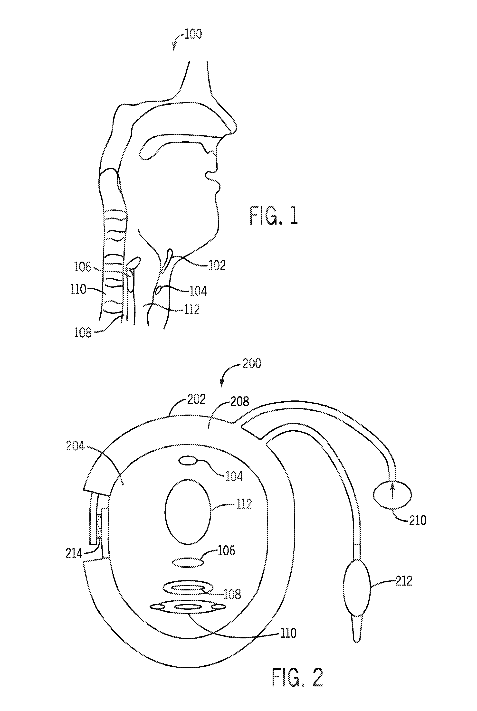 Compression device and pressure sensor for treatment of abnormal upper esophageal sphincter functionality