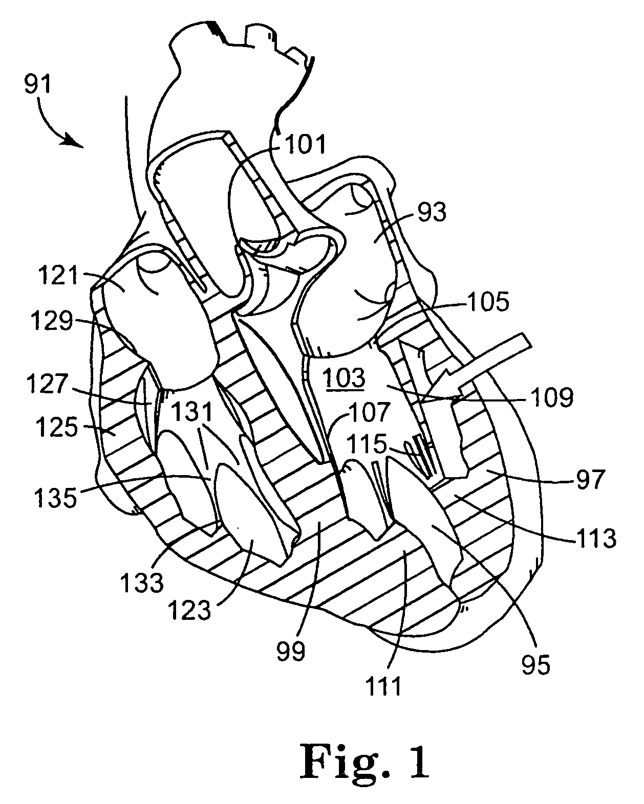 Valve treatment catheter and methods