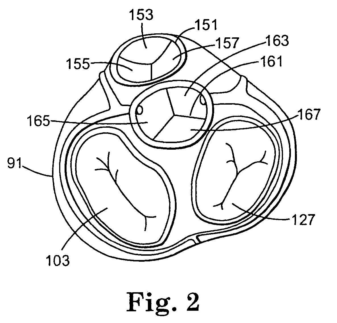 Valve treatment catheter and methods