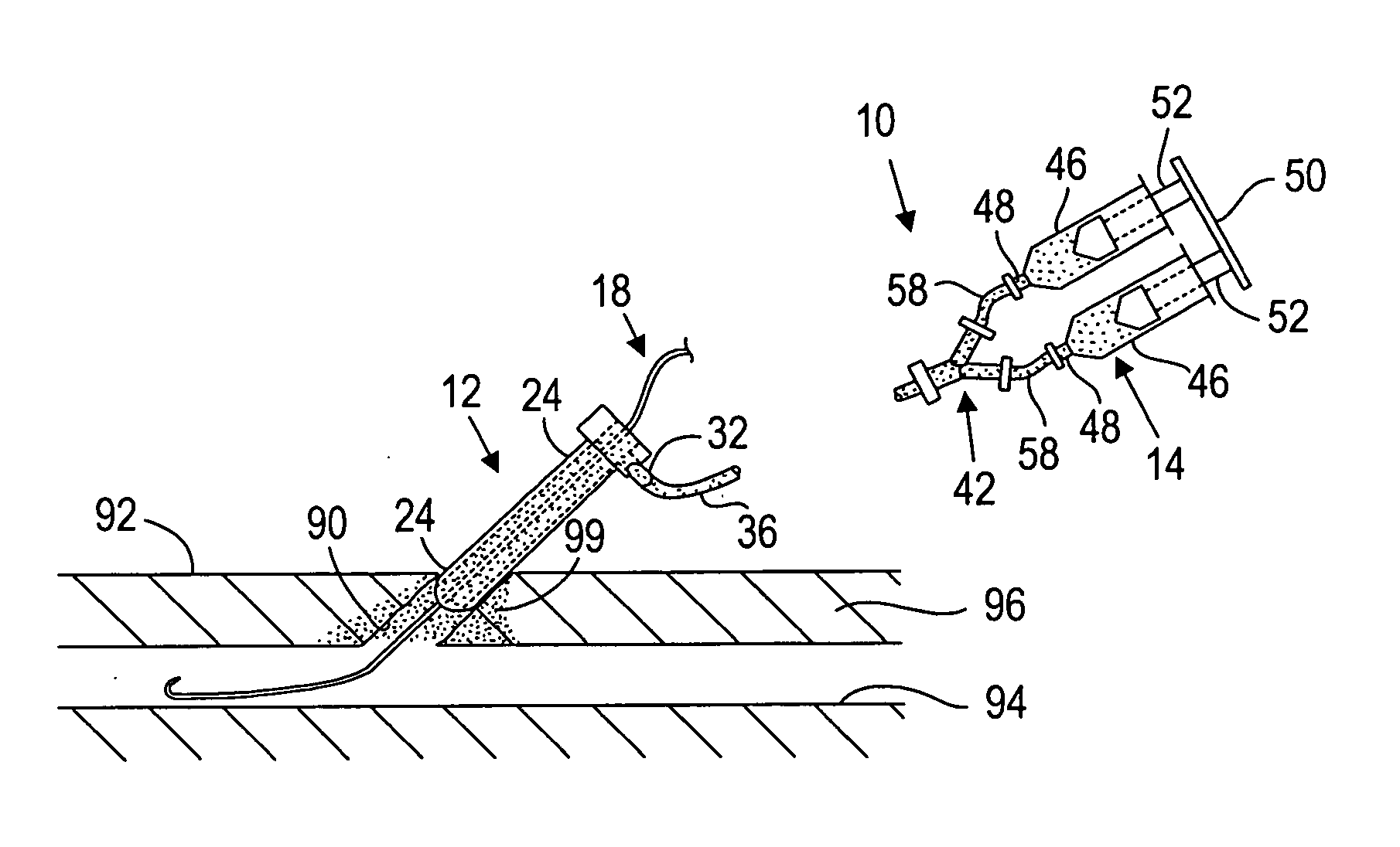 Apparatus and methods for delivering sealing materials during a percutaneous procedure to facilitate hemostasis
