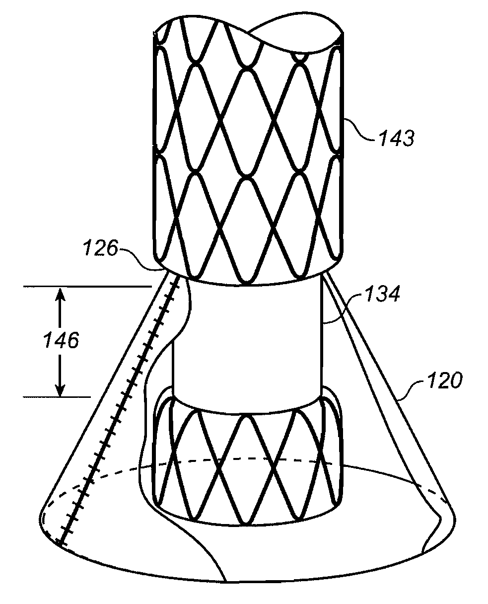 Mobile external coupling with internal sealing cuff for branch vessel connection
