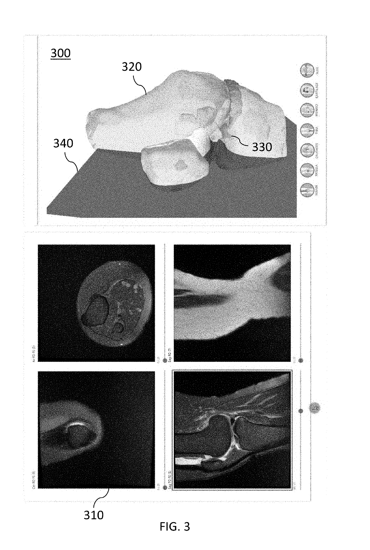 Determination and visualization of damage to an anatomical joint
