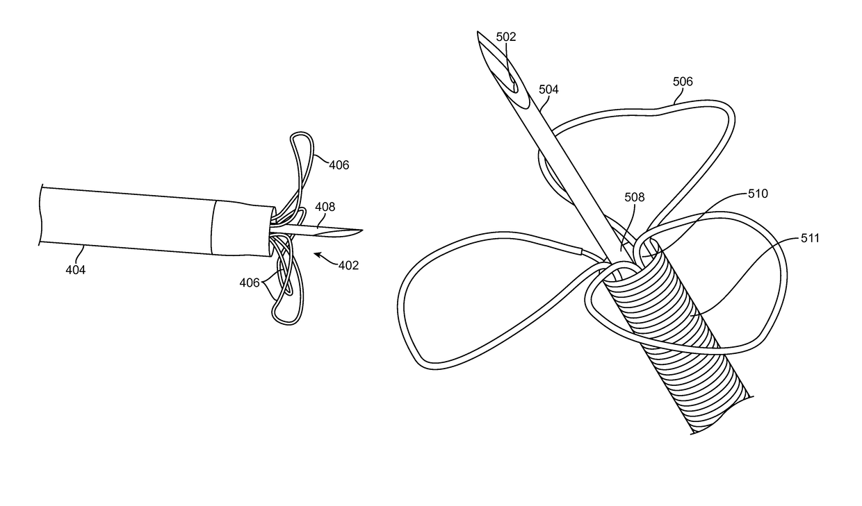 Radial and trans-endocardial delivery catheter