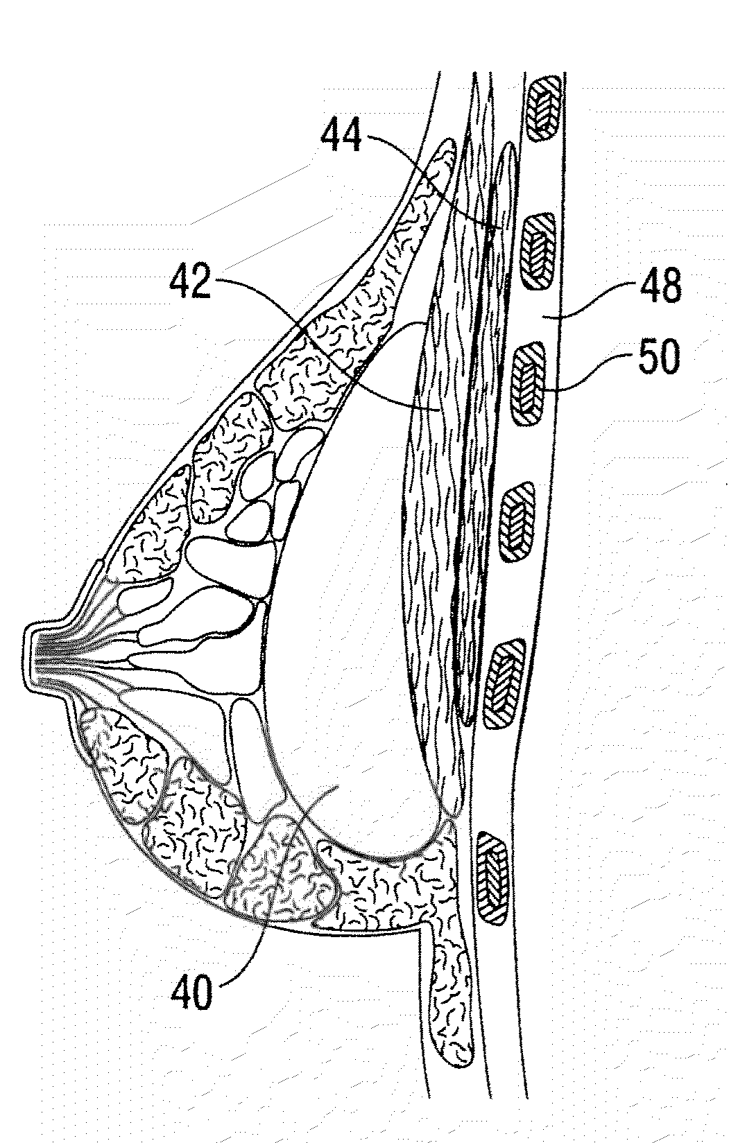 Soft Filled Prosthesis Shell With Discrete Fixation Surfaces