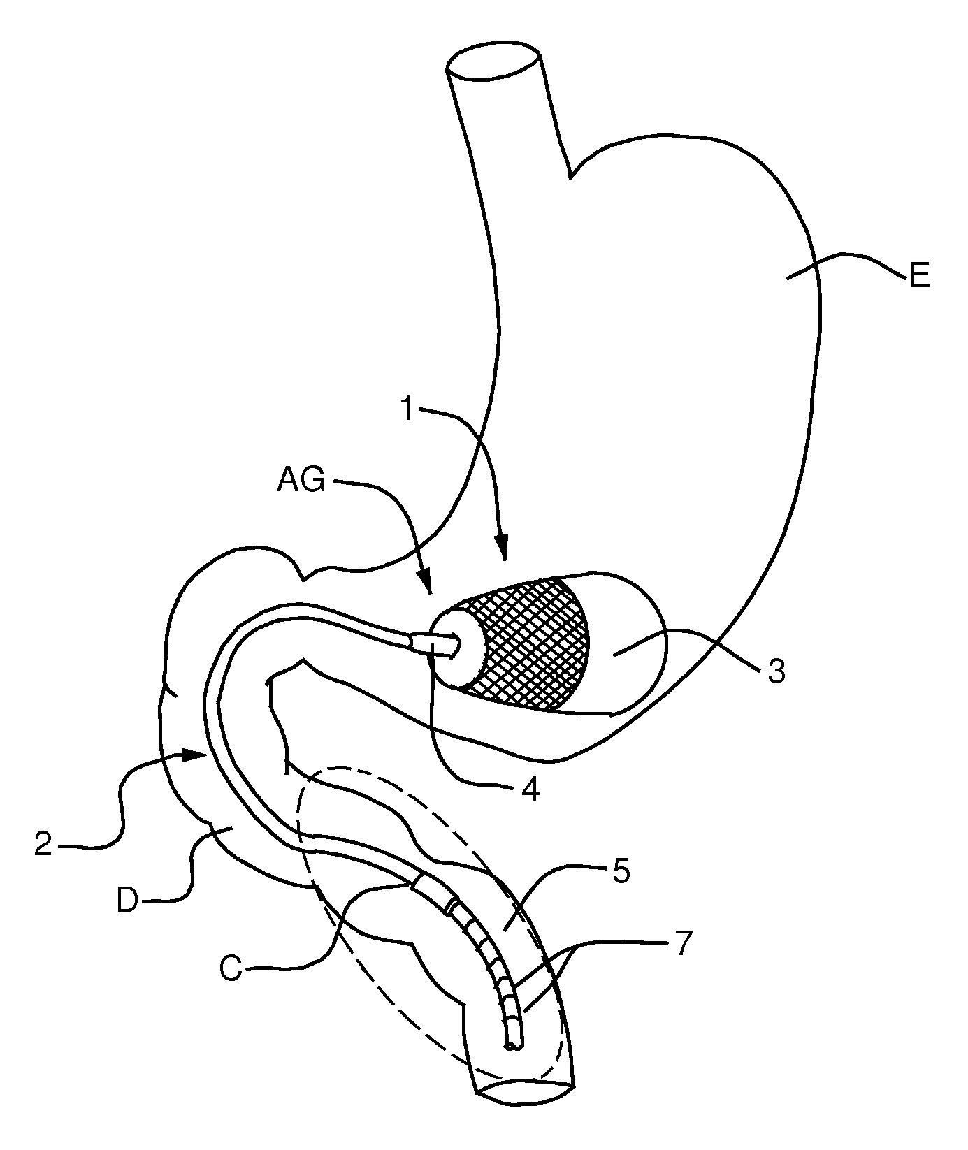 Semi-stationary balloon in the gastric antrum provided with connecting an anchoring rod for inducing weight reduction in human beings