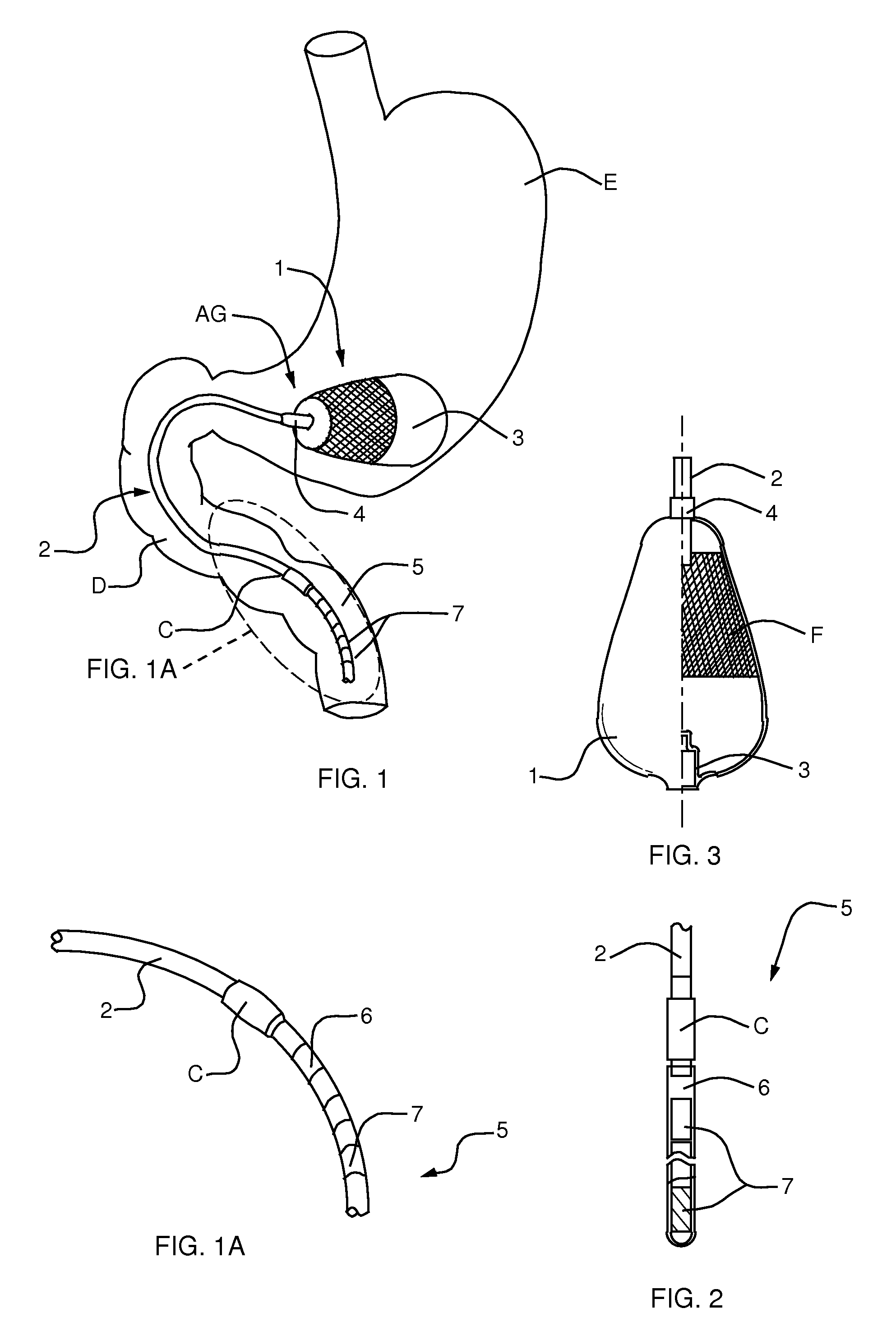 Semi-stationary balloon in the gastric antrum provided with connecting an anchoring rod for inducing weight reduction in human beings