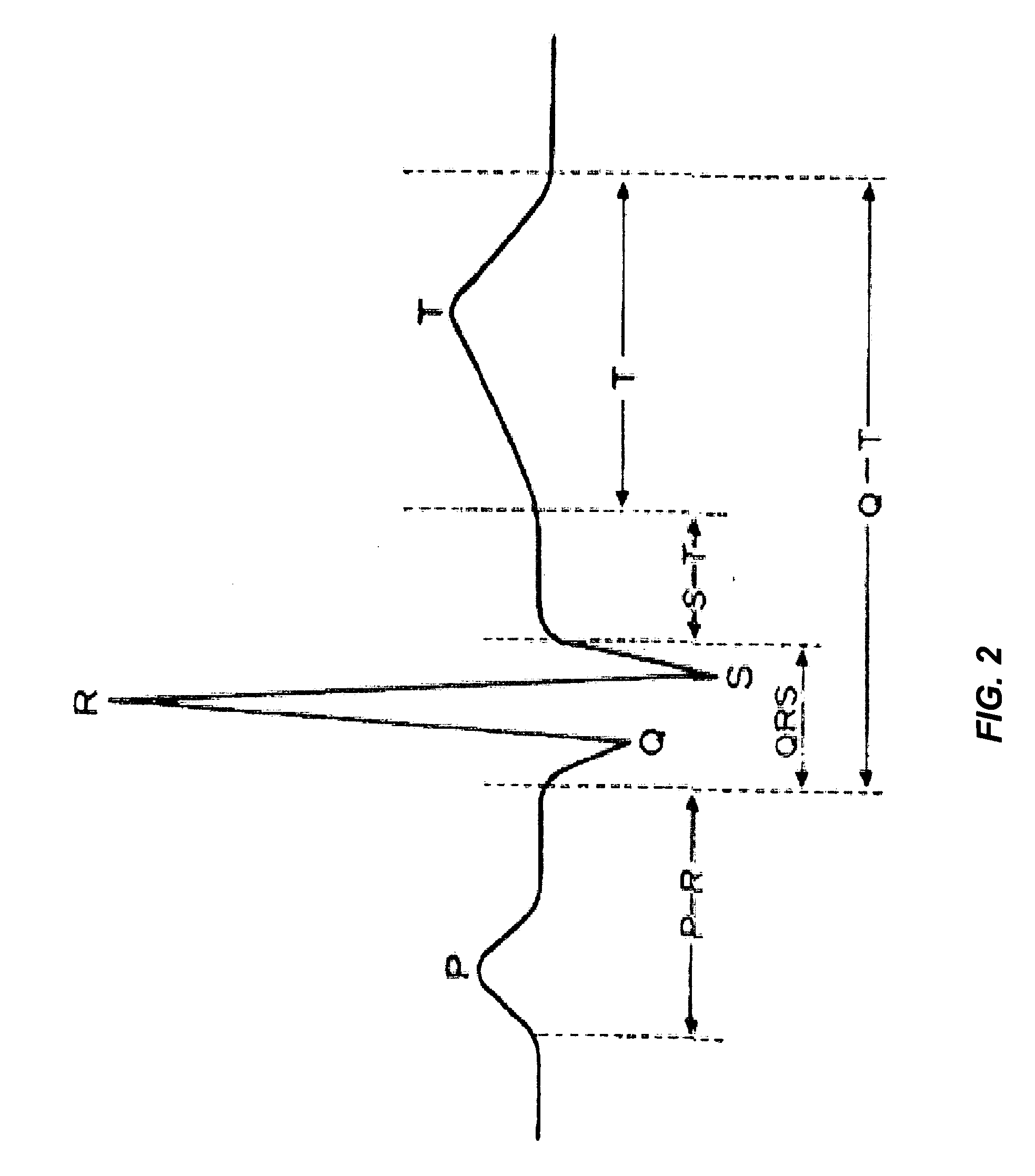 Method and apparatus for transfer of captured electrocardiogram data