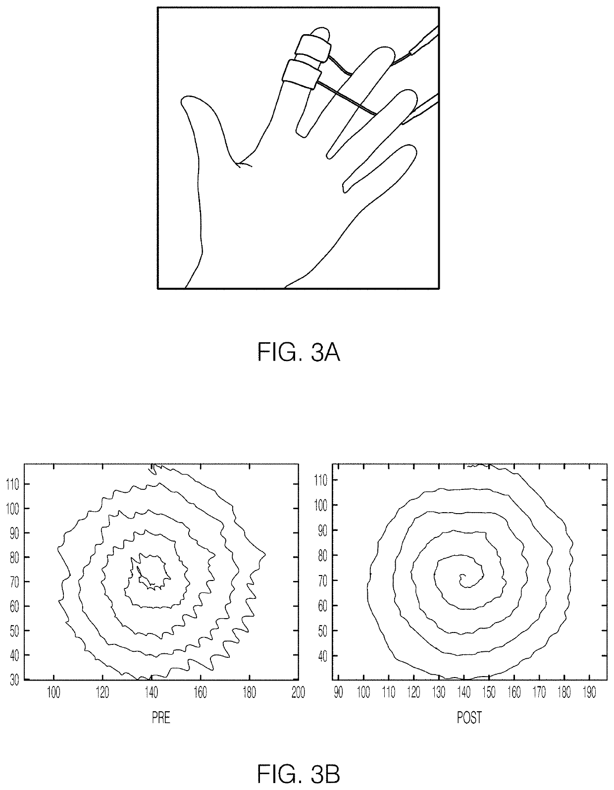 Systems and methods for peripheral nerve stimulation in the finger or hand to treat hand tremors